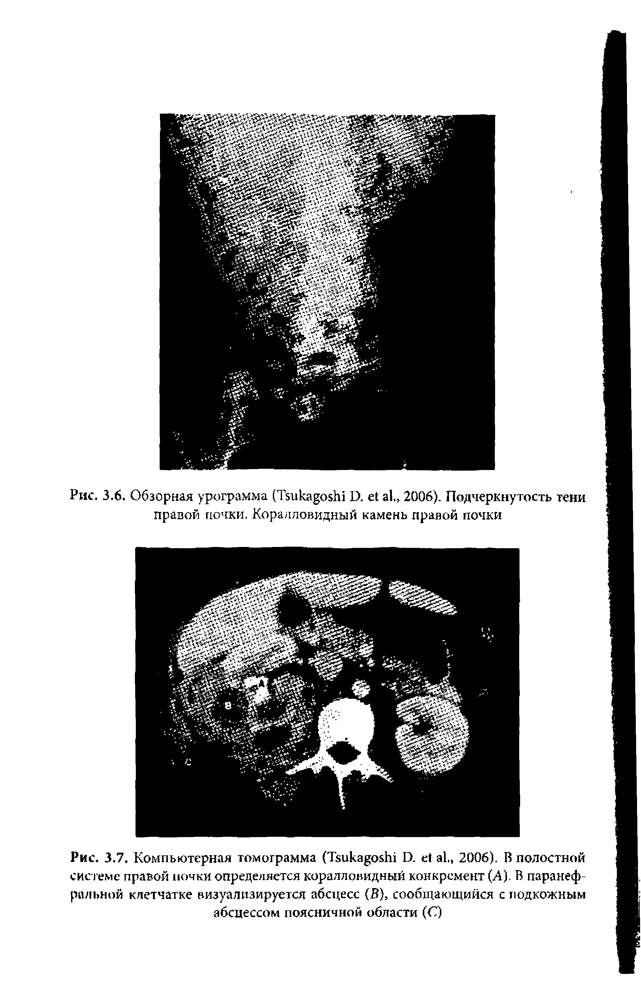 Рис. 3.7, Компьютерная томограмма (Тзик оБЫ Э. е1 а1 2006). В полостной системе правой почки определяется коралловидный конкремент (А). В паранеф-ральной клетчатке визуализируется абсцесс (В), сообщающийся с подкожным абсцессом поясничной области (С)...