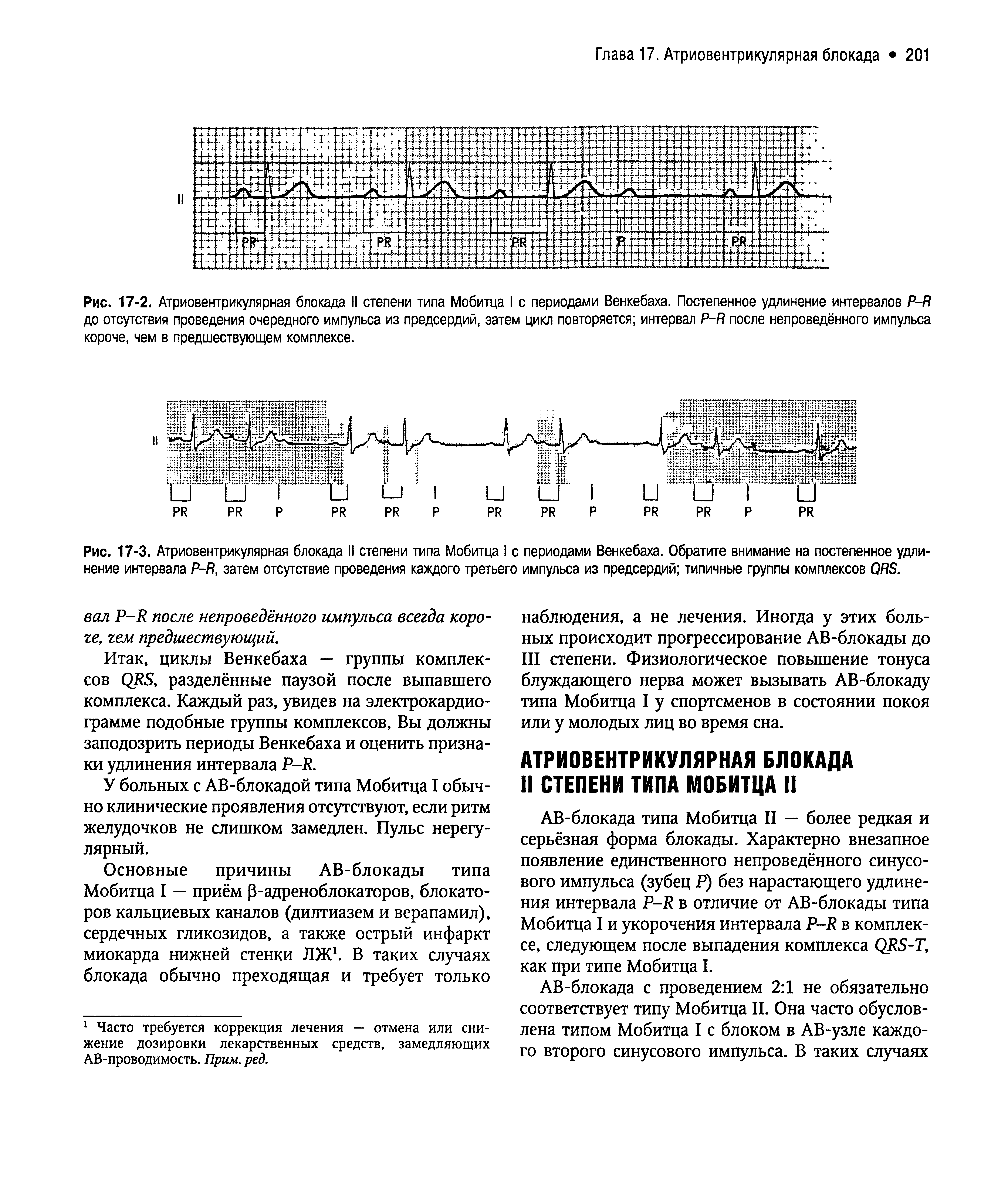 Рис. 17-2. Атриовентрикулярная блокада II степени типа Мобитца I с периодами Венкебаха. Постепенное удлинение интервалов Р-Я до отсутствия проведения очередного импульса из предсердий, затем цикл повторяется интервал Р-Я после непроведённого импульса короче, чем в предшествующем комплексе.