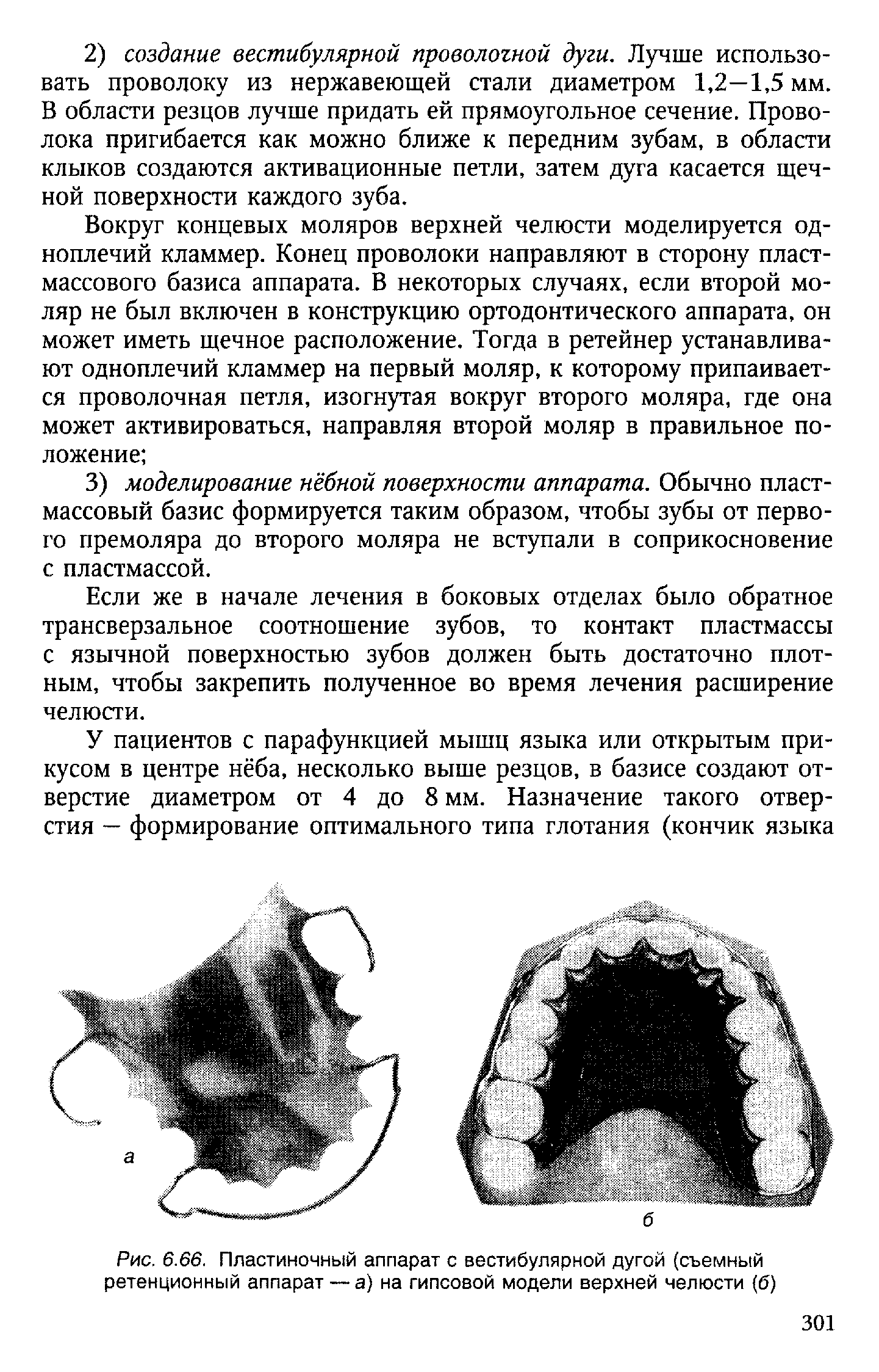 Рис. 6.66. Пластиночный аппарат с вестибулярной дугой (съемный ретенционный аппарат — а) на гипсовой модели верхней челюсти (б)...