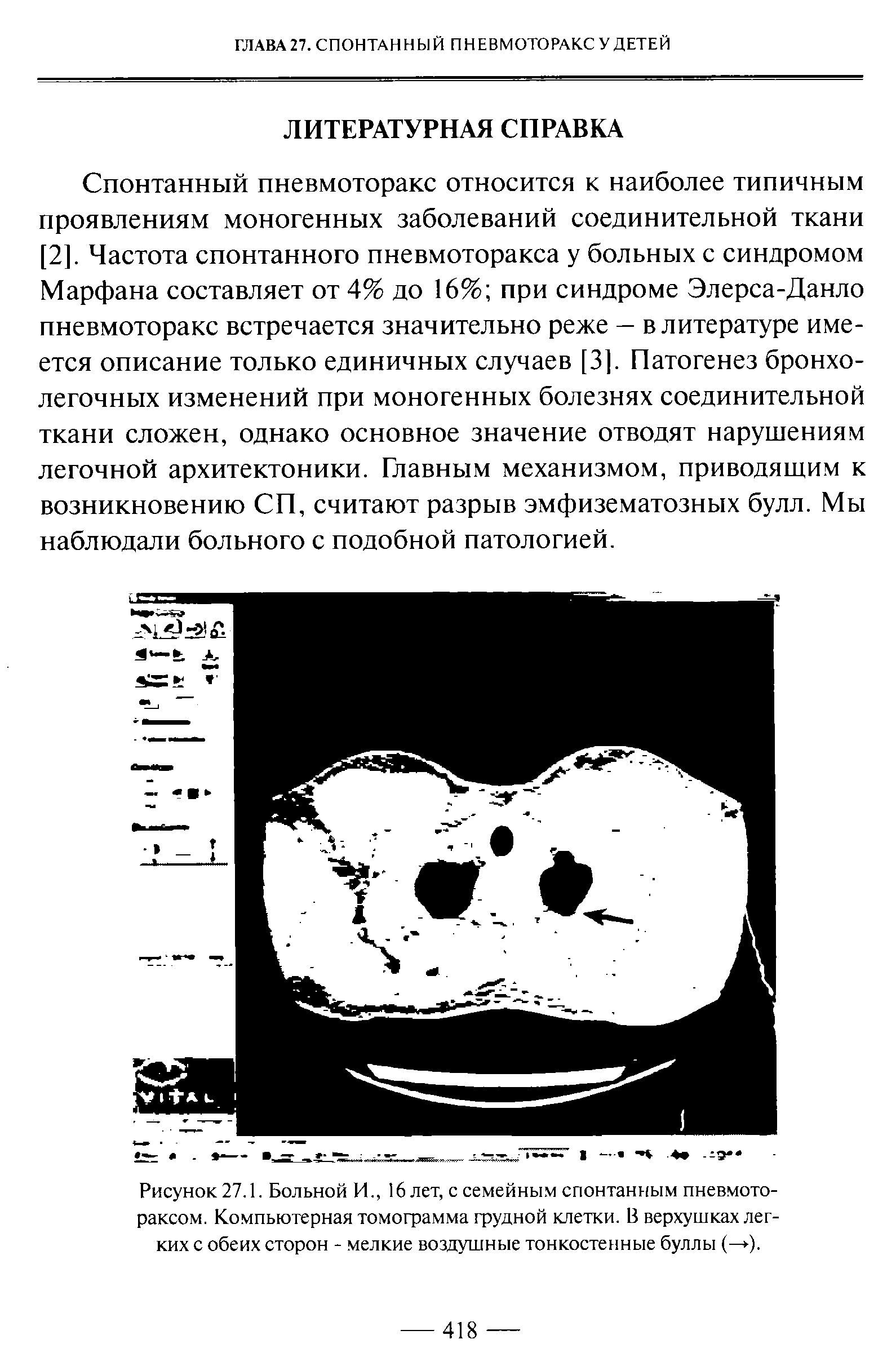 Рисунок 27.1. Больной И., 16 лет, с семейным спонтанным пневмотораксом. Компьютерная томограмма грудной клетки. В верхушках легких с обеих сторон - мелкие воздушные тонкостенные буллы (— ).