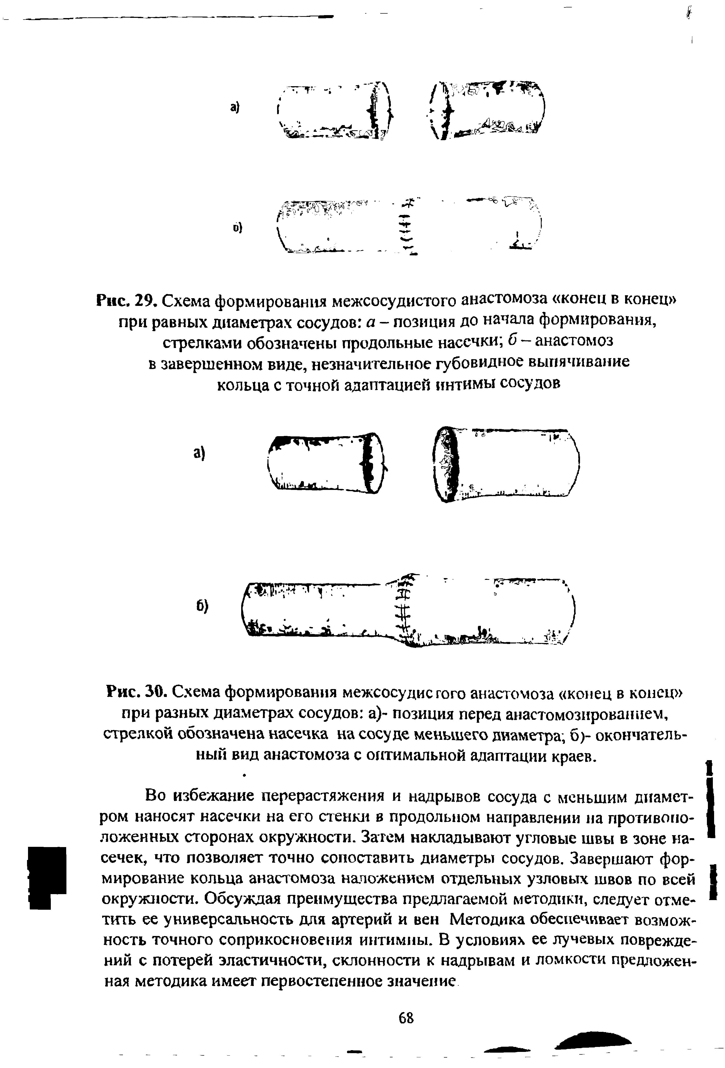 Рис. 29. Схема формирования межсосудистого анастомоза конец в конец при равных диаметрах сосудов а - позиция до начала формирования, стрелками обозначены продольные насечки б-анастомоз в завершенном виде, незначительное губовидное выпячивание кольца с точной адаптацией интимы сосудов...