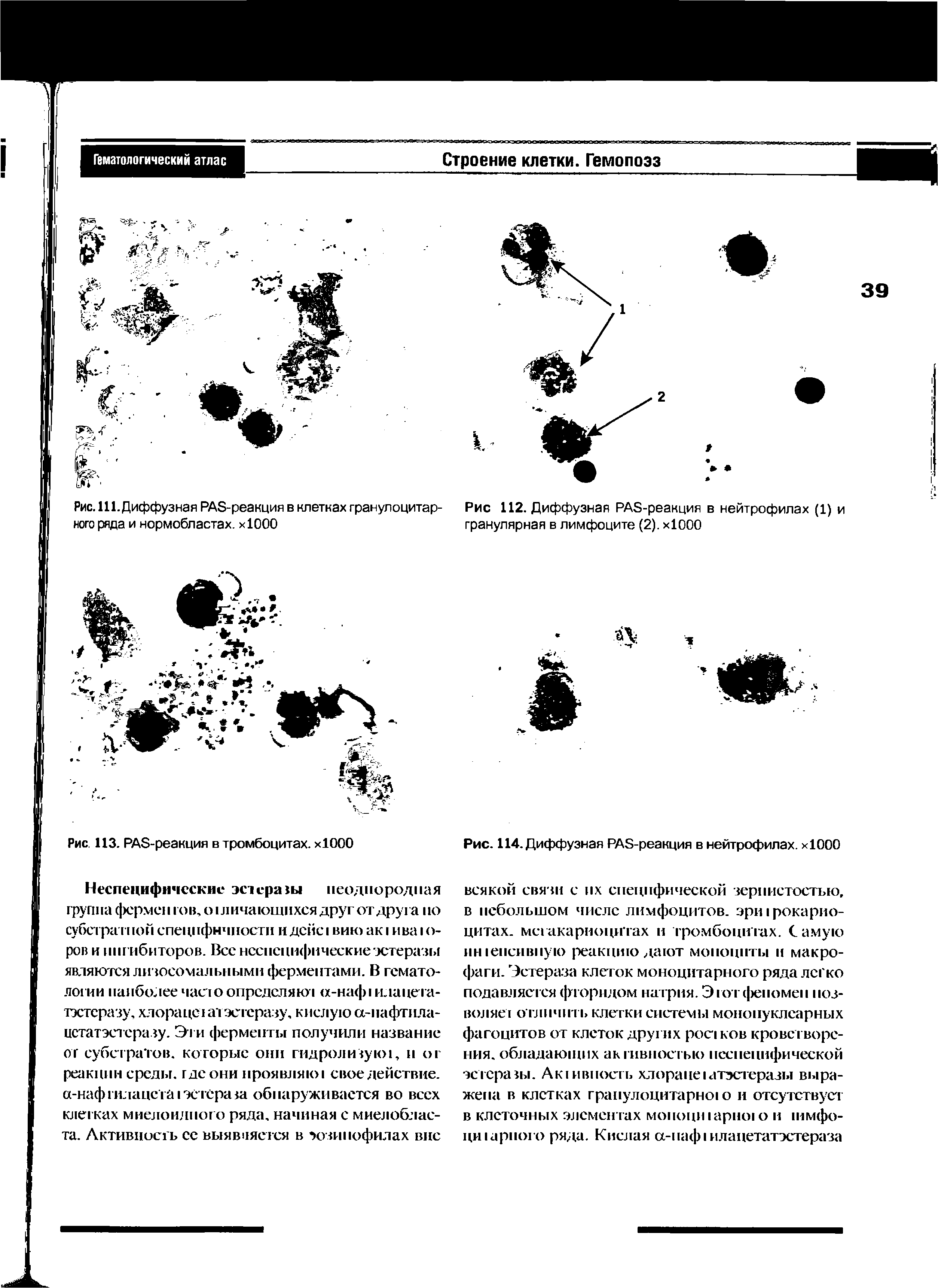 Рис. 111. Диффузная PAS-реакция в клетках гранулоцитарного ряда и нормобластах. хЮОО...