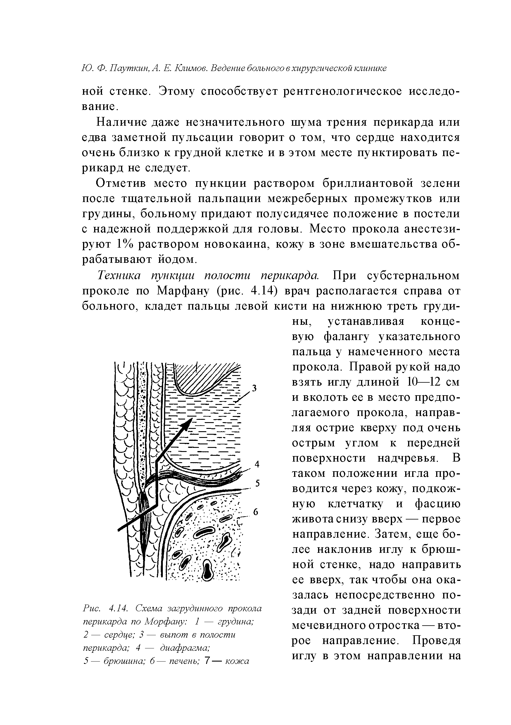 Рис. 4.14. Схема загрудинного прокола перикарда по Морфану 1 — грудина ...