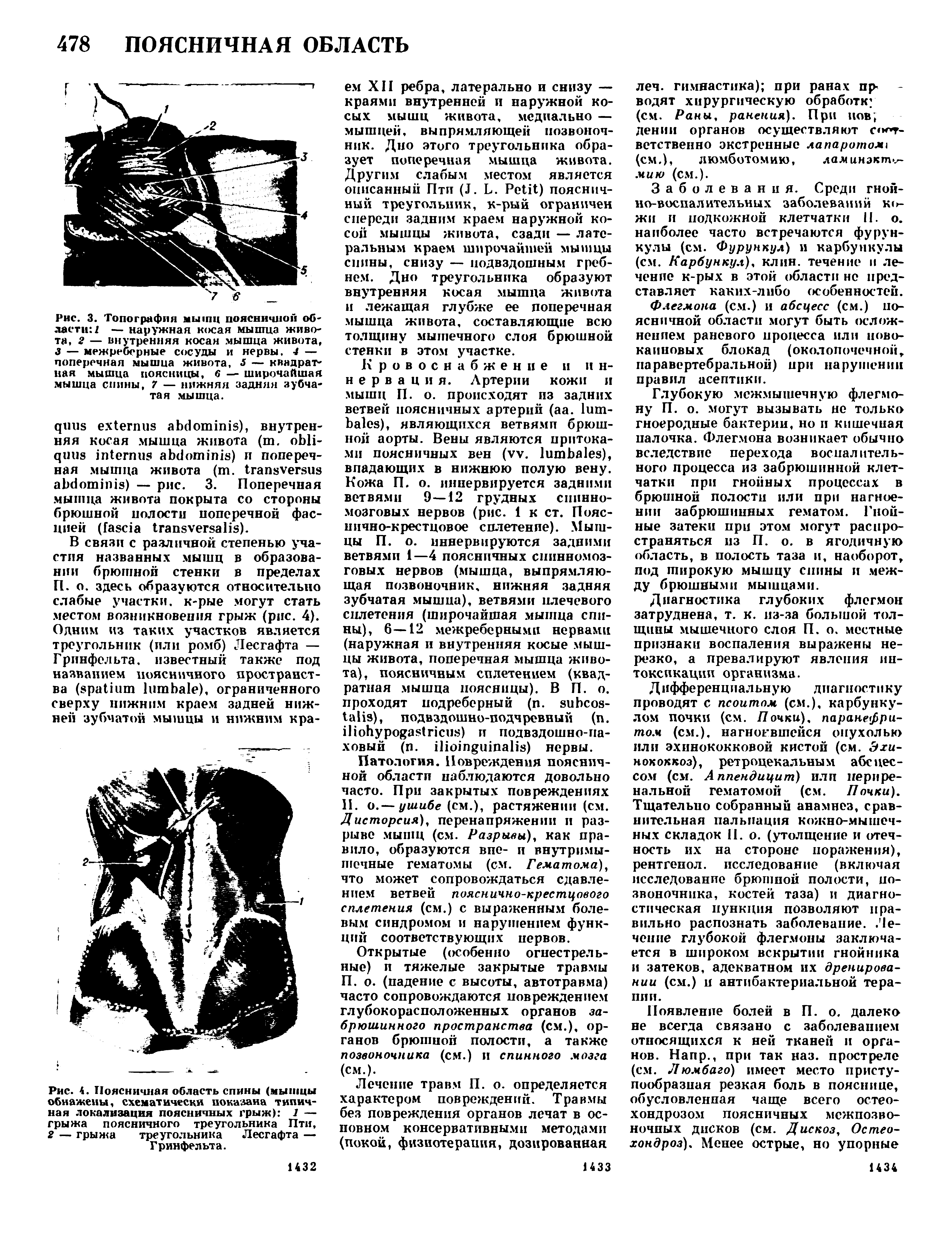 Рис. 4. Поясничная область спины (мышцы обнажены, схематически показана типичная локализация поясничных грыж) 1 — грыжа поясничного треугольника Пти, 2 — грыжа треугольника Лесгафта — Гринфельта.