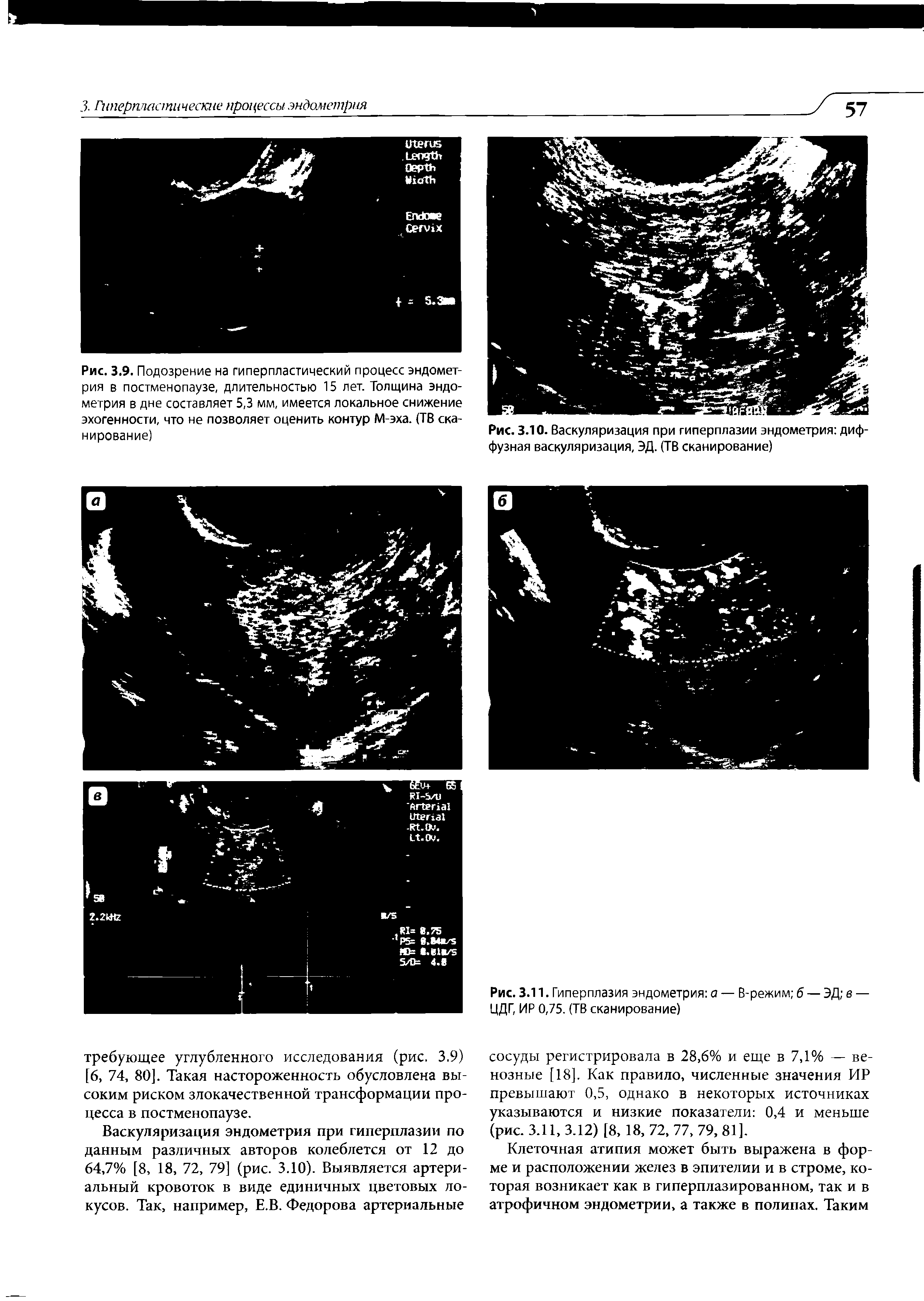 Рис. 3.10. Васкуляризация при гиперплазии эндометрия диффузная васкуляризация, ЭД. (ТВ сканирование)...