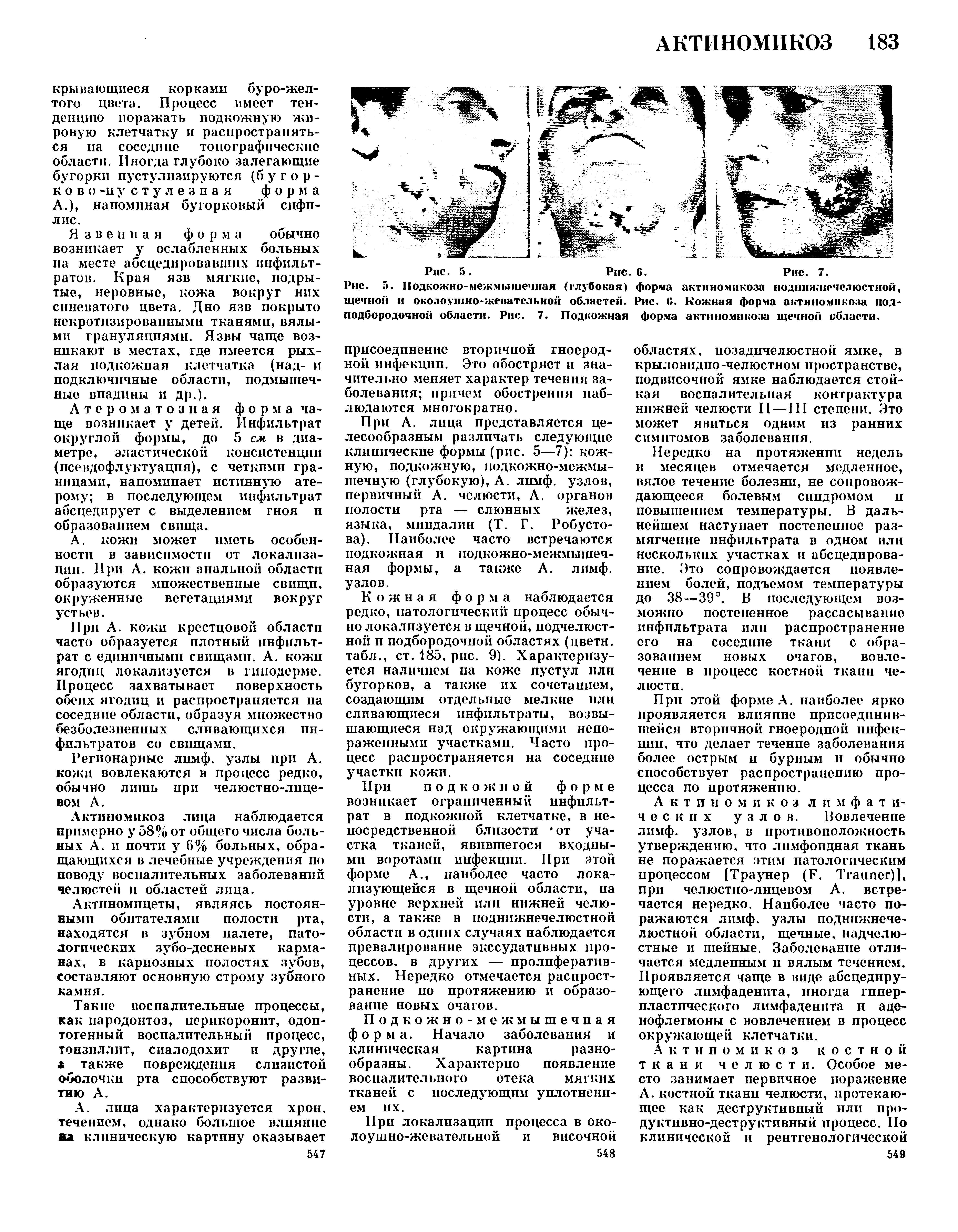 Рис. 5. Подкожно-межмышечная (глубокая) форма актиномикоза поднижнечелюстной, щечной и околоушно-жевательной областей. Рис. б. Кожная форма актиномикоза подподбородочной области. Рис. 7. Подкожная форма актиномикоза щечной области.