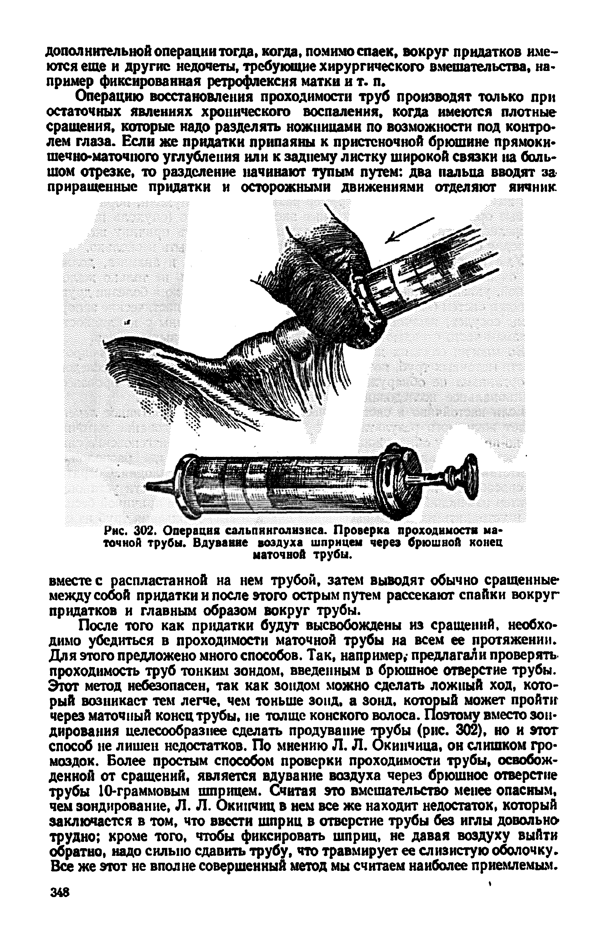 Рис. 302. Операция сальпинголизнса. Проверка проходимости маточной трубы. Вдувание воздуха шприцем через брюшной конец маточной трубы.