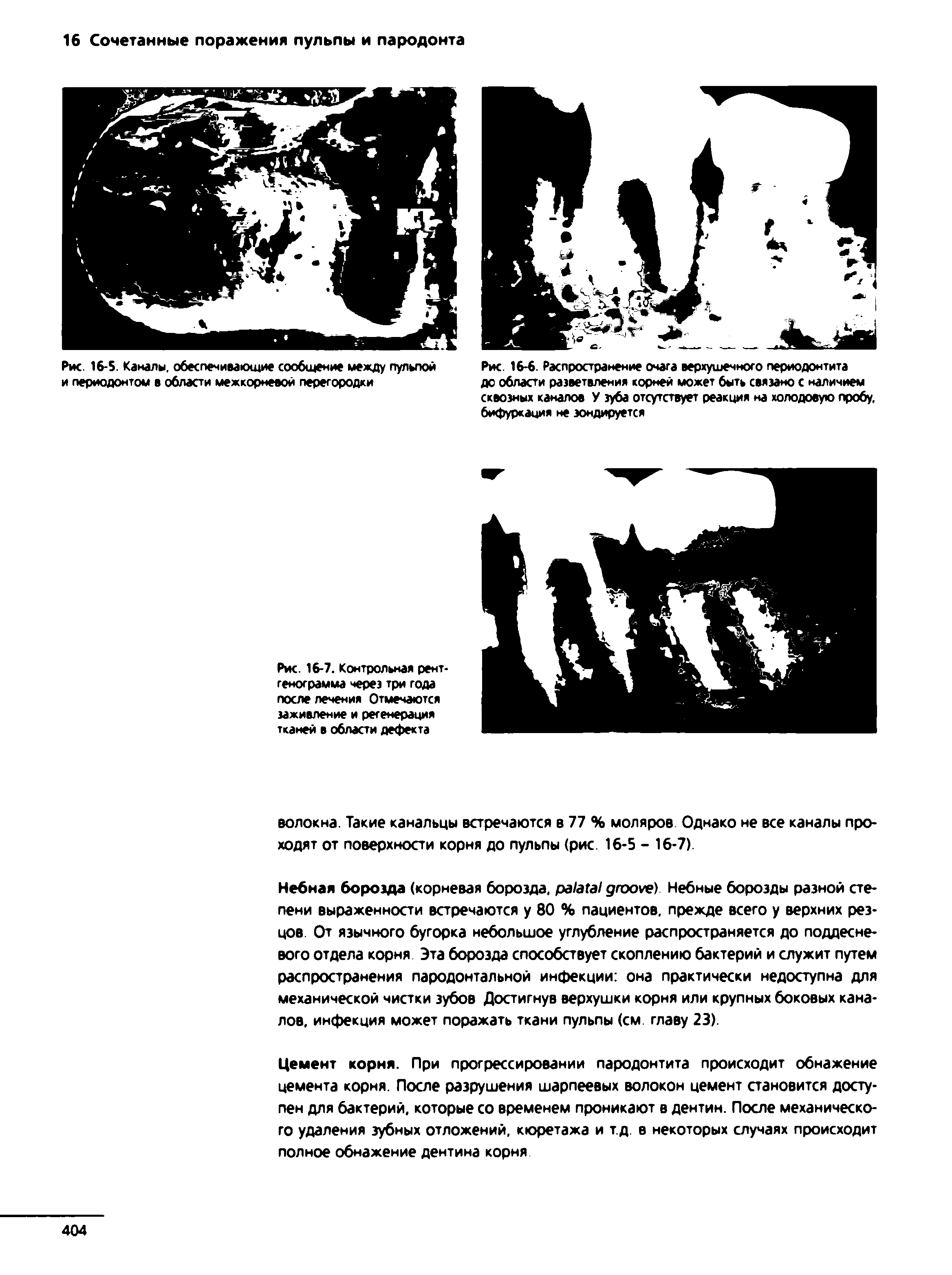 Рис. 16-5. Каналы, обеспечивающие сообщение между пульпой и периодонтом в области межкорневой перегородки...