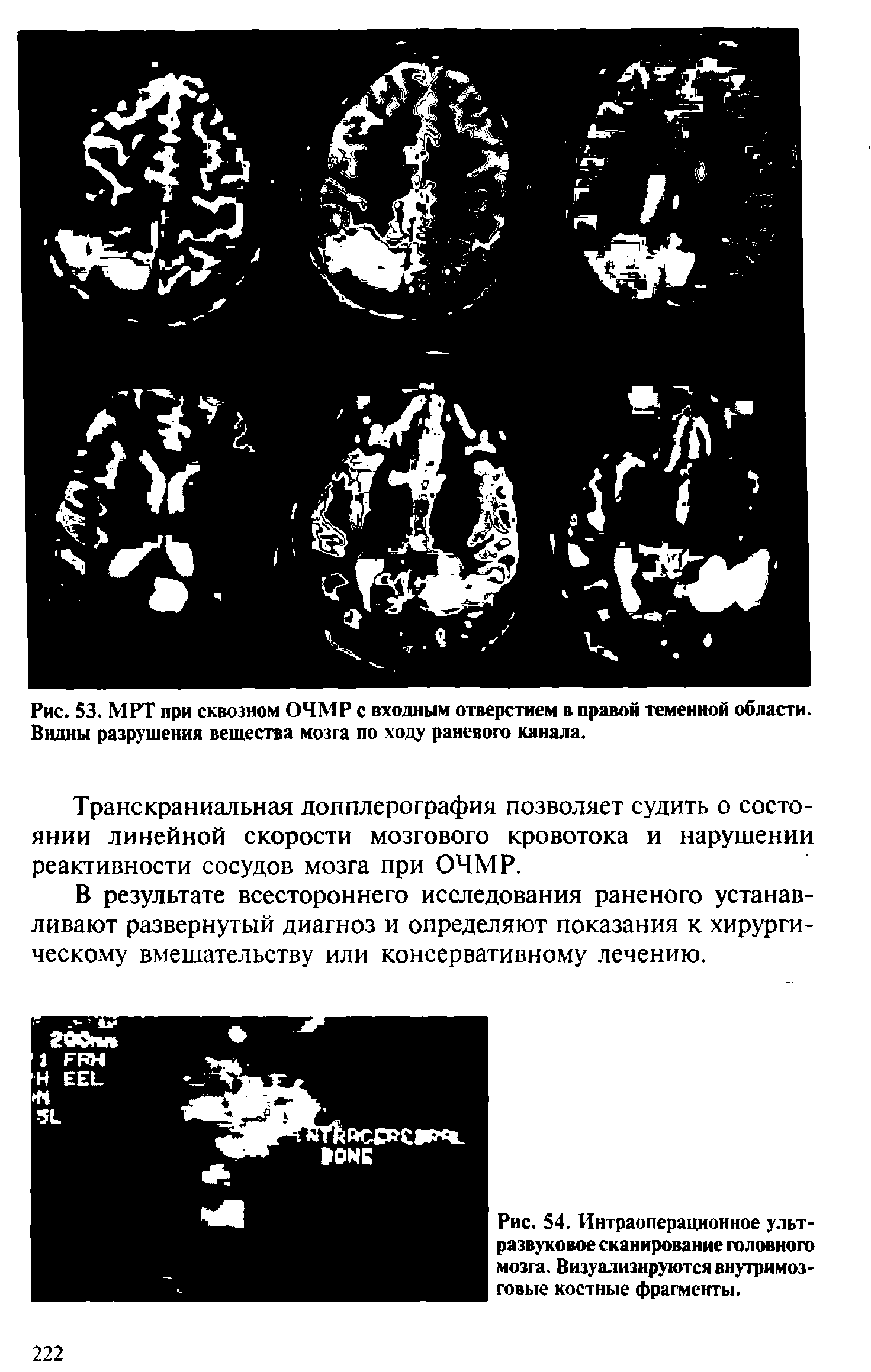 Рис. 54. Интраоперационное ультразвуковое сканирование головного мозга. Визуализируются внутримозговые костные фрагменты.