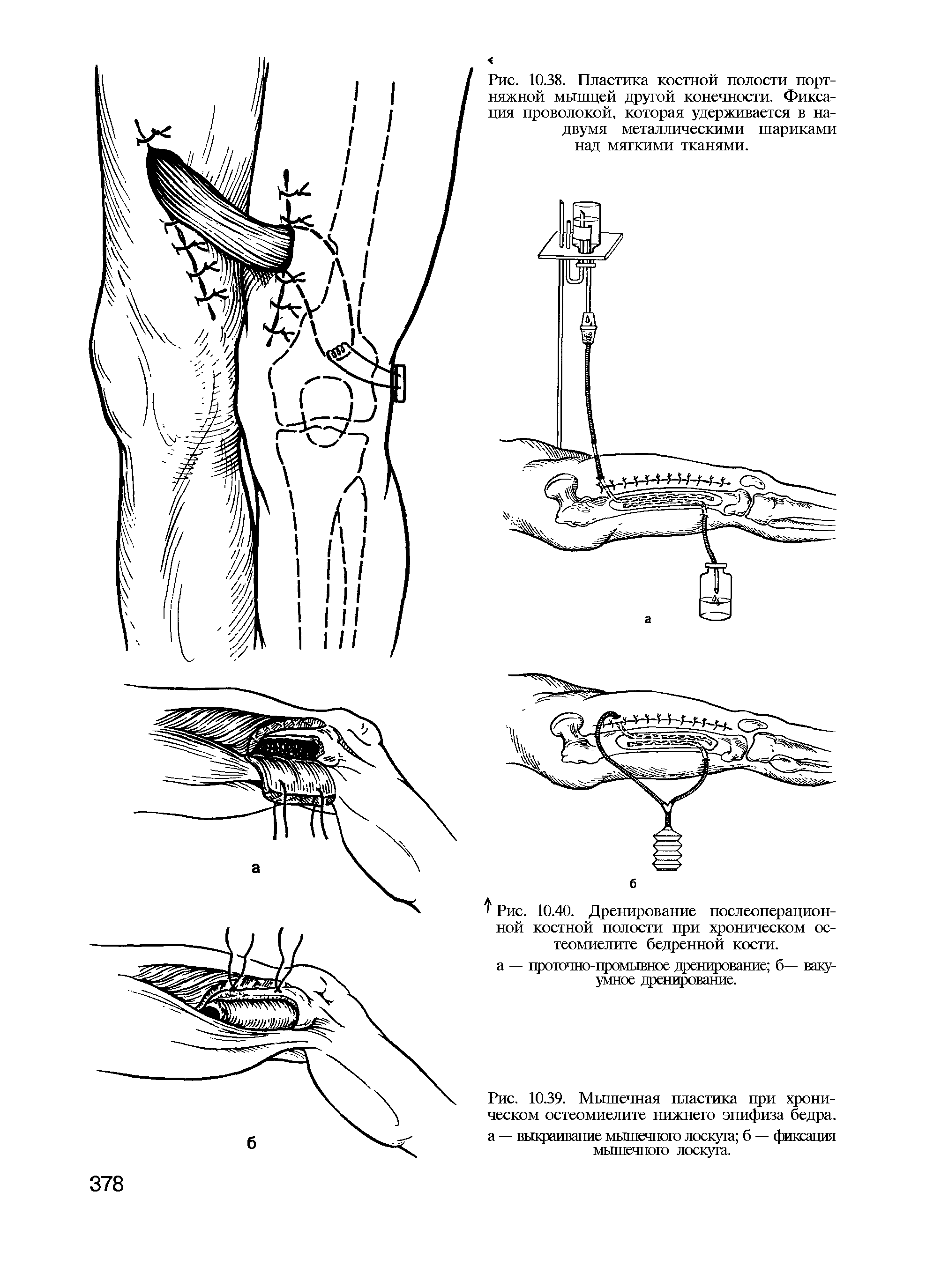 Рис. 10.39. Мышечная пластика при хроническом остеомиелите нижнего эпифиза бедра, а — выкраивание мышечного лоскута б — фиксация мышечного лоскута.