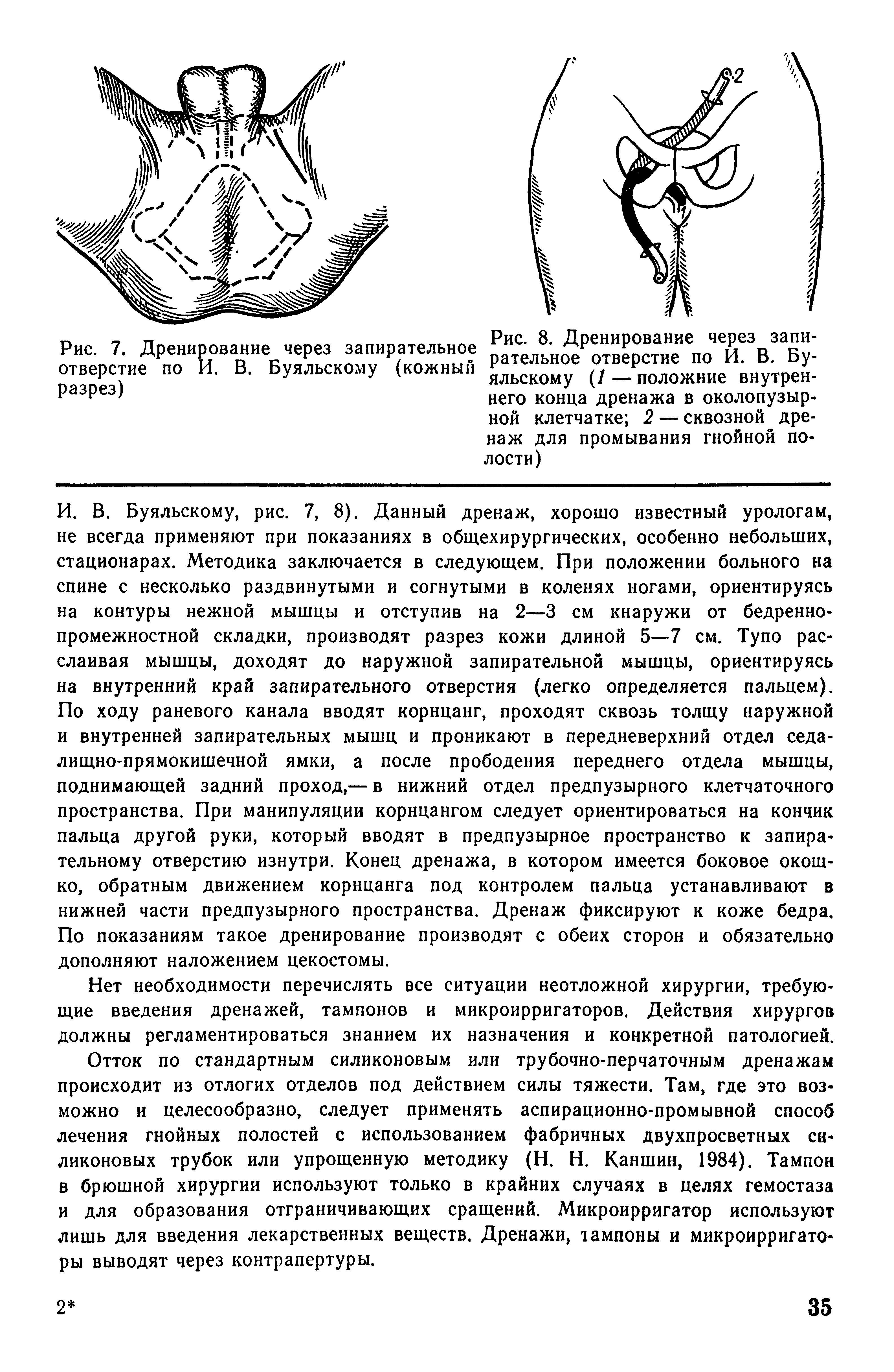 Рис. 8. Дренирование через запирательное отверстие по И. В. Буяльскому (/ — положние внутреннего конца дренажа в околопузырной клетчатке 2 — сквозной дренаж для промывания гнойной полости)...