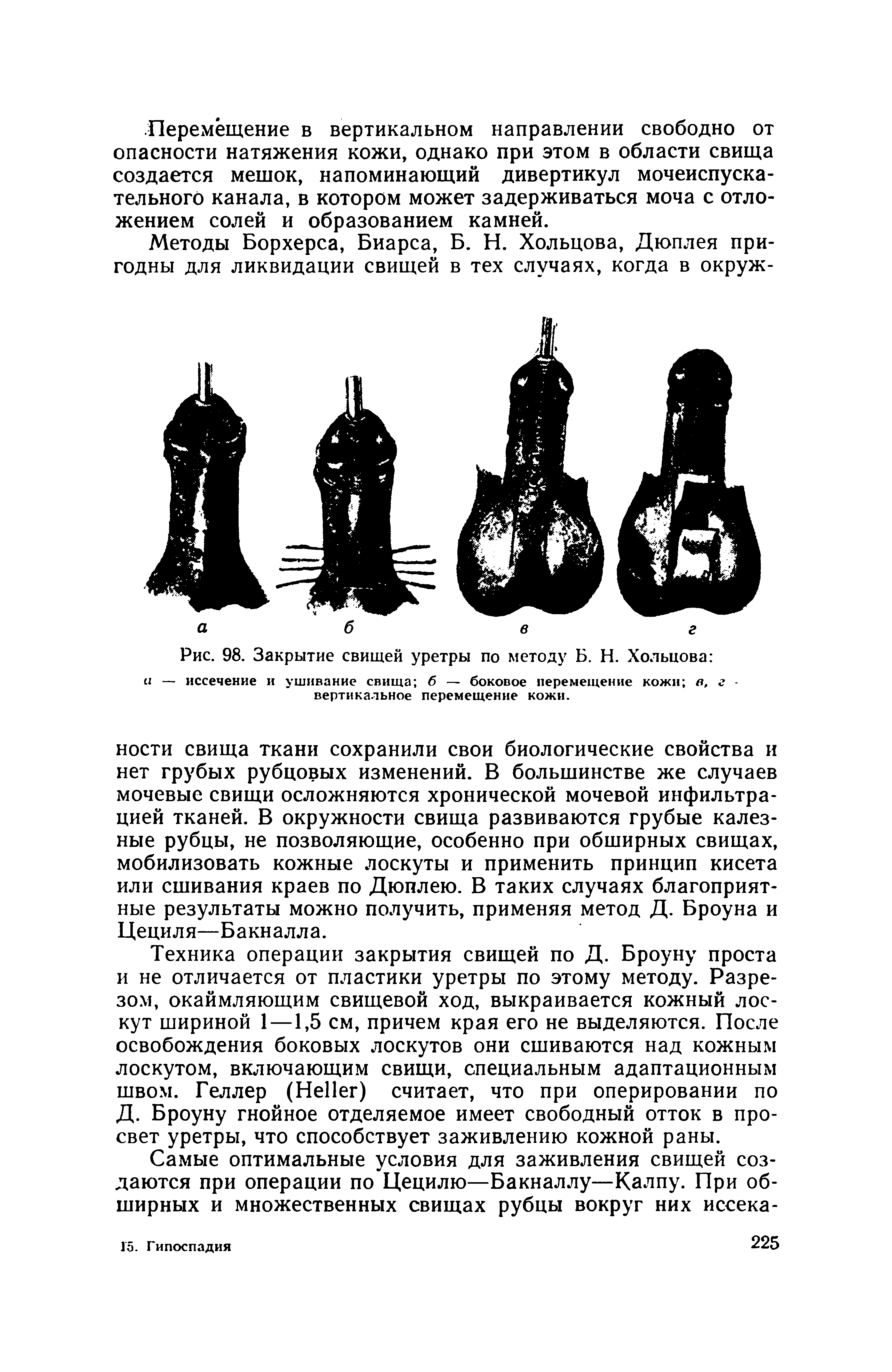 Рис. 98. Закрытие свищей уретры по методу Б. Н. Хольцова а — иссечение и ушивание свища б — боковое перемещение кожи в, г -вертикальное перемещение кожи.