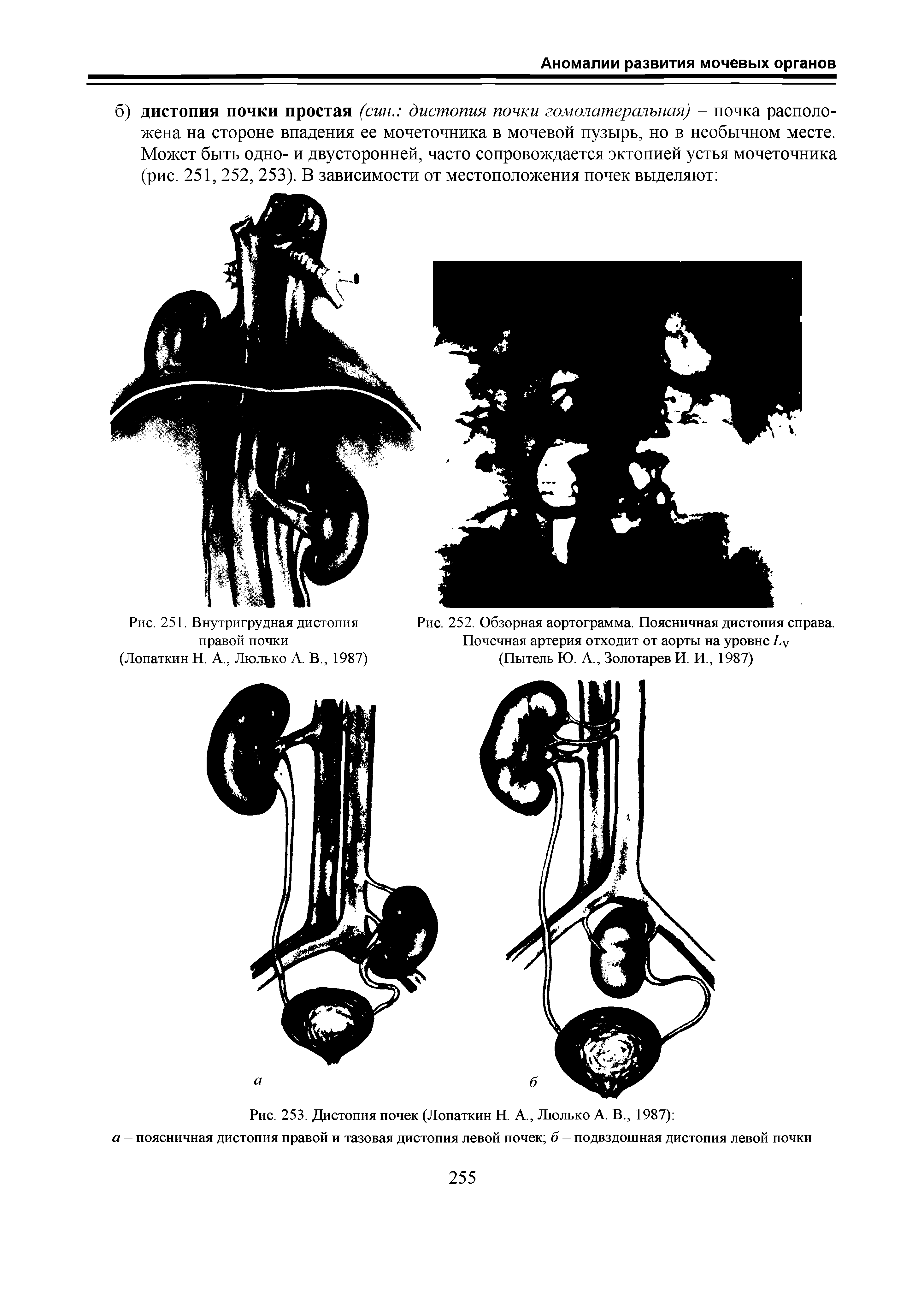 Рис. 251. Внутригрудная дистопия правой почки (Лопаткин Н. А., Люлько А. В., 1987)...