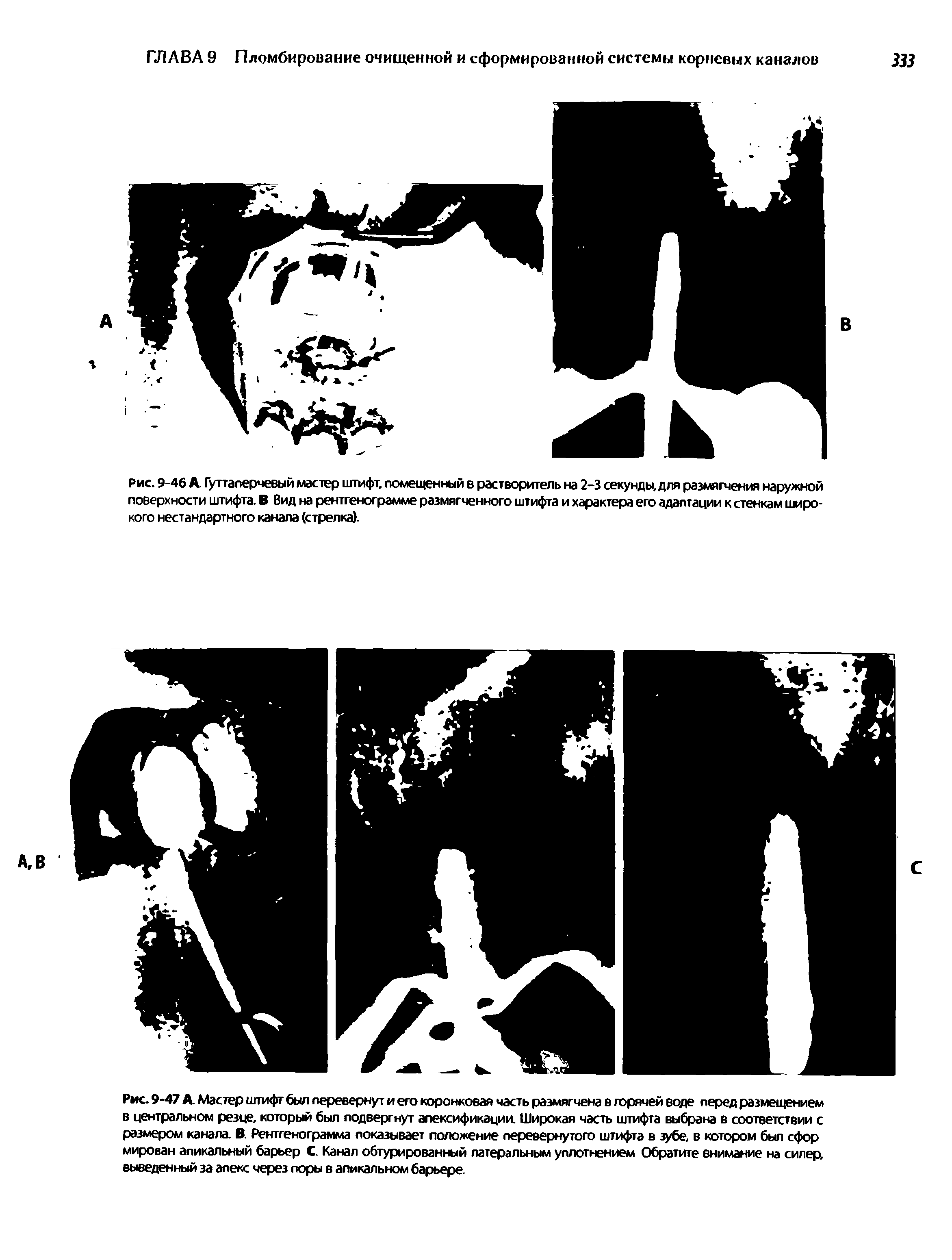 Рис. 9-46 А. Гуттаперчевый мастер штифт, помещенный в растворитель на 2-3 секунды, для размягчения наружной поверхности штифта. В Вид на рентгенограмме размягченного штифта и характера его адаптации к стенкам широкого нестандартного канала (стрелка).