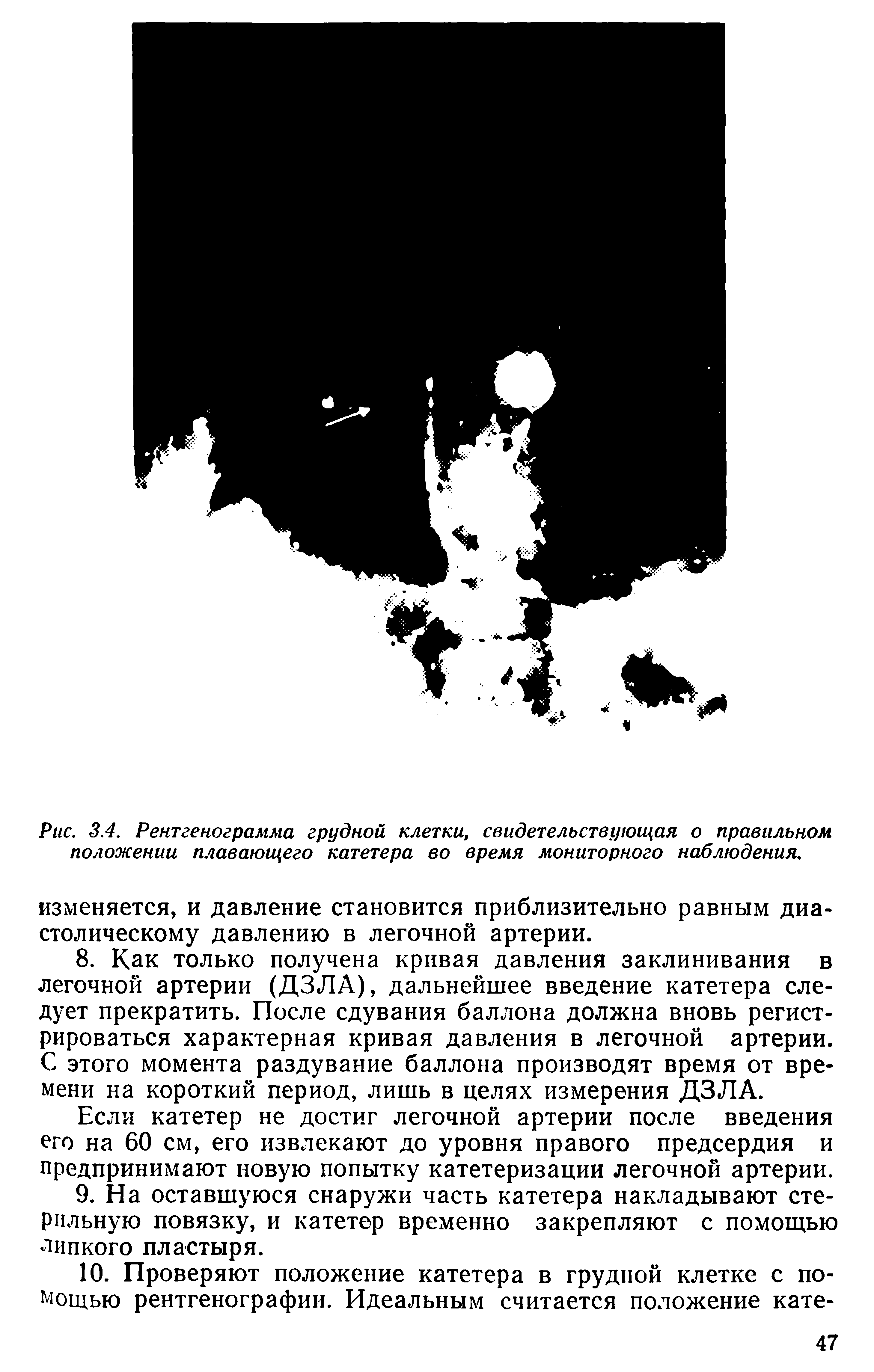 Рис. 3.4. Рентгенограмма грудной клетки, свидетельствующая о правильном положении плавающего катетера во время мониторного наблюдения,...