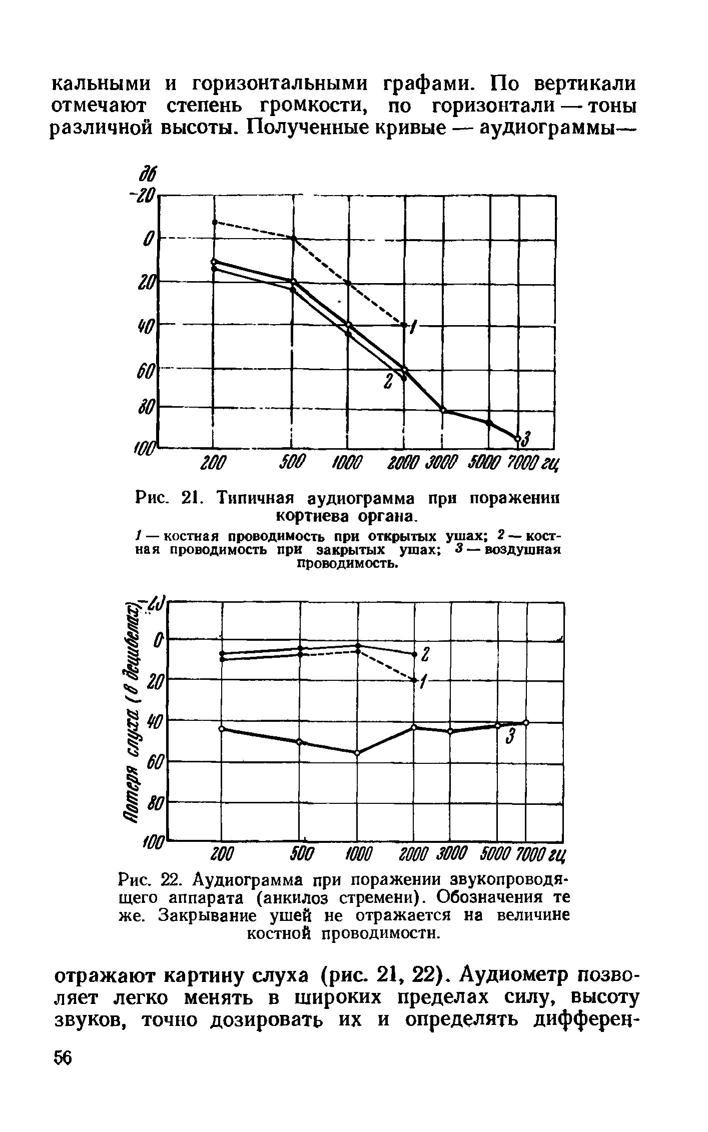 Рис. 22. Аудиограмма при поражении звукопроводящего аппарата (анкилоз стремени). Обозначения те же. Закрывание ушей не отражается на величине костной проводимости.