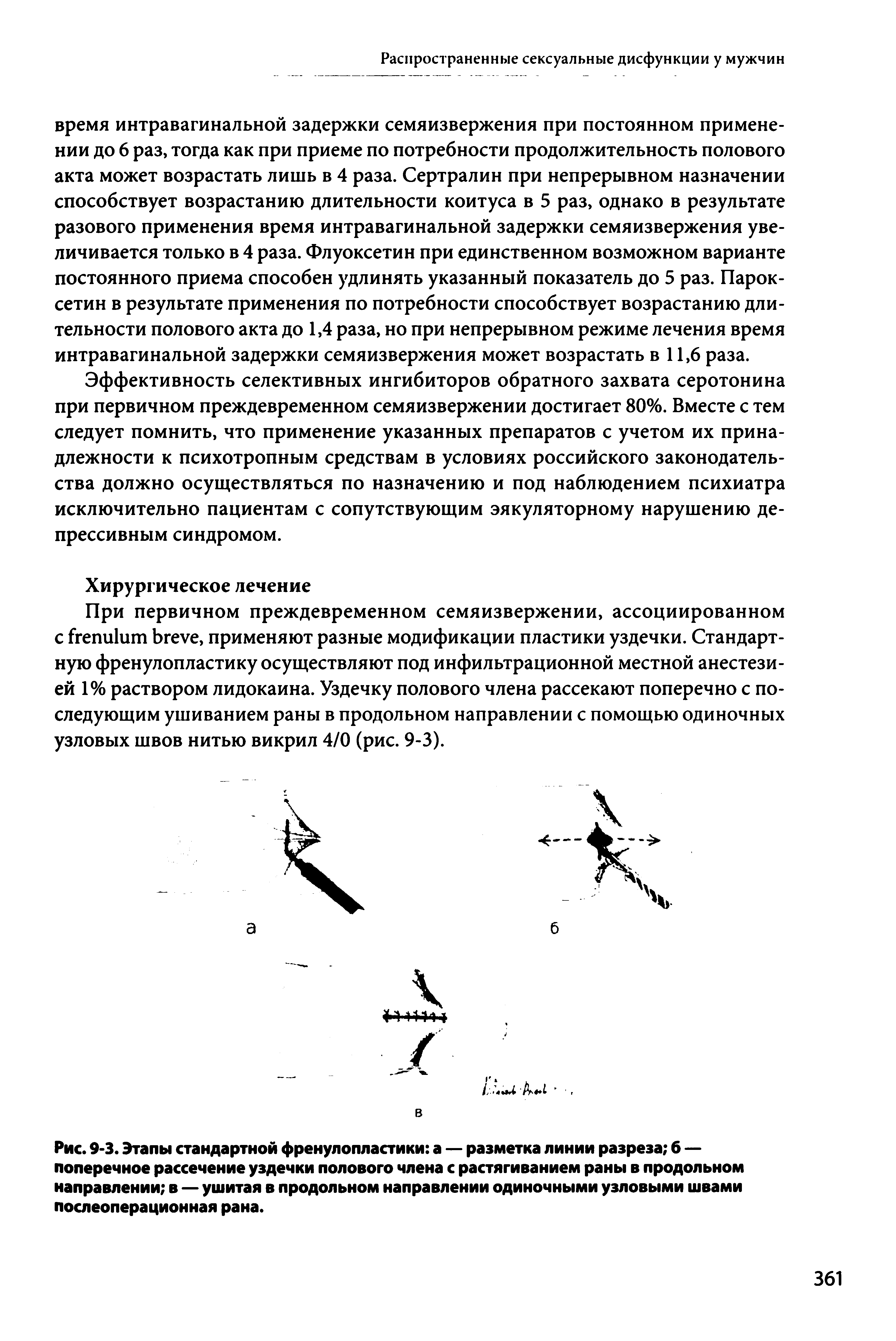 Рис. 9-3. Этапы стандартной френулопластики а — разметка линии разреза б — поперечное рассечение уздечки полового члена с растягиванием раны в продольном направлении в — ушитая в продольном направлении одиночными узловыми швами послеоперационная рана.