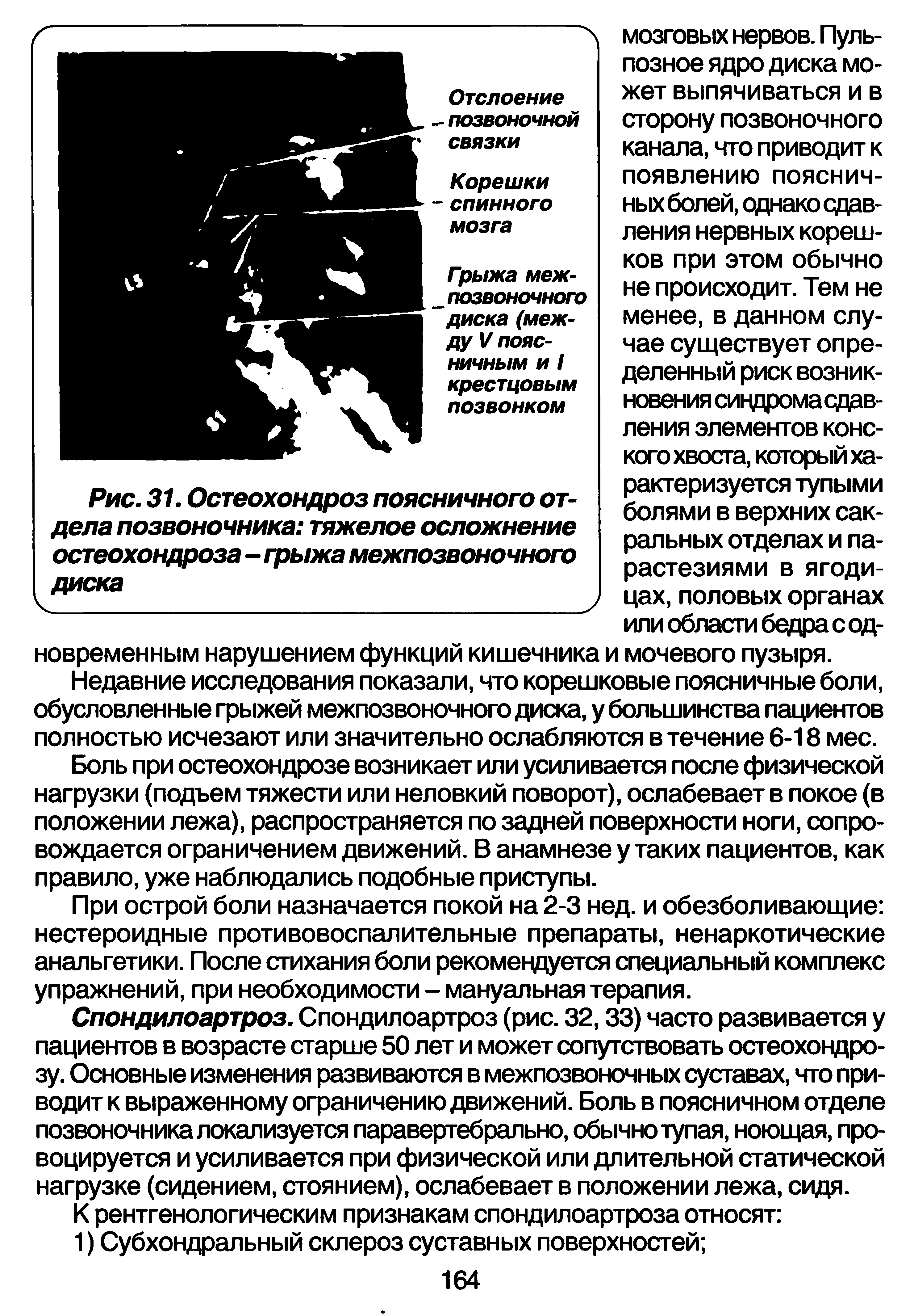 Рис. 31. Остеохондроз поясничного отдела позвоночника тяжелое осложнение остеохондроза - грыжа межпозвоночного диска...