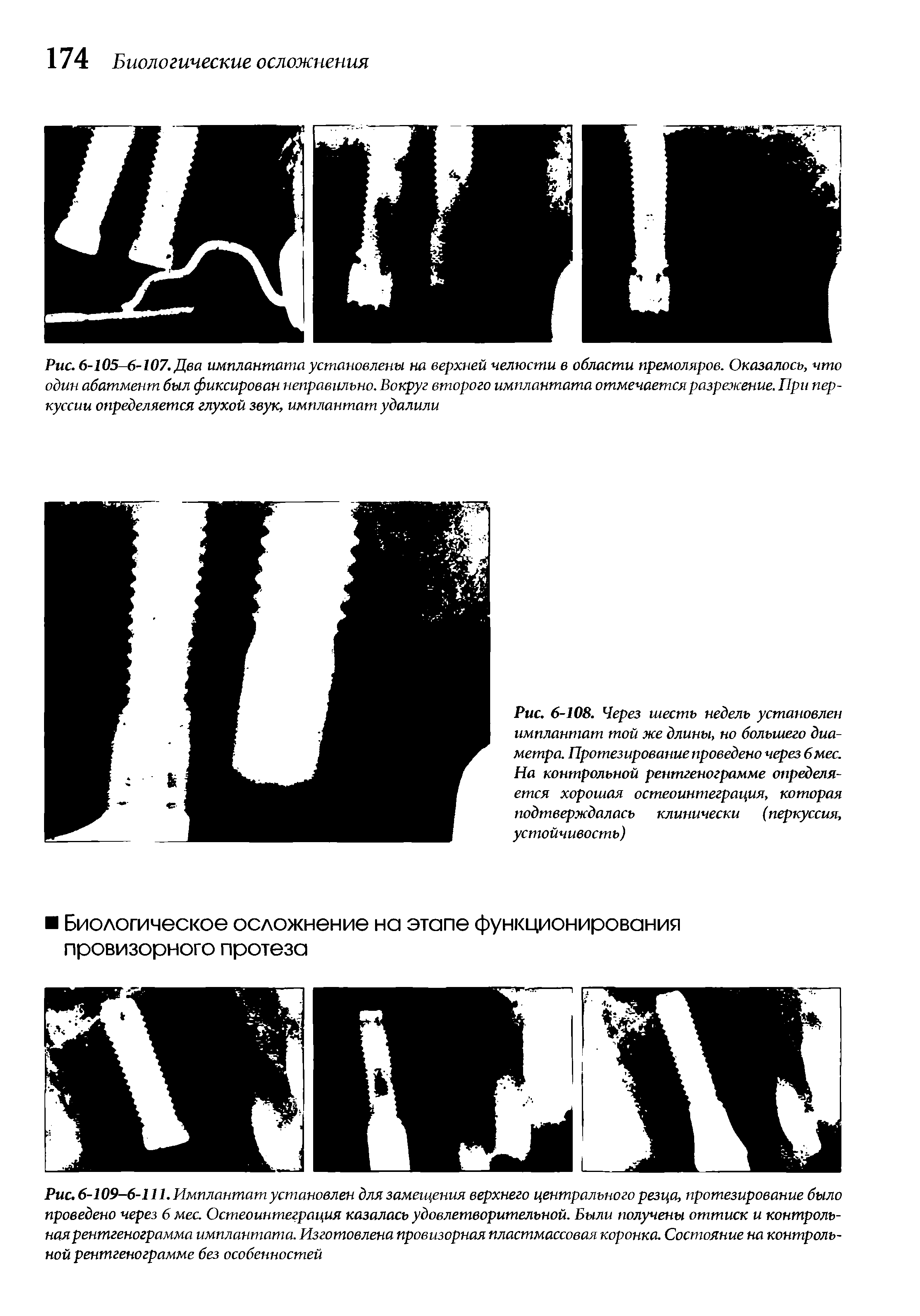 Рис. 6-105-6-107. Два имплантата установлены на верхней челюсти в области премоляров. Оказалось, что один абатмент был фиксирован неправильно. Вокруг второго имплантата отмечается разрежение. При перкуссии определяется глухой звук, имплантат удалили...