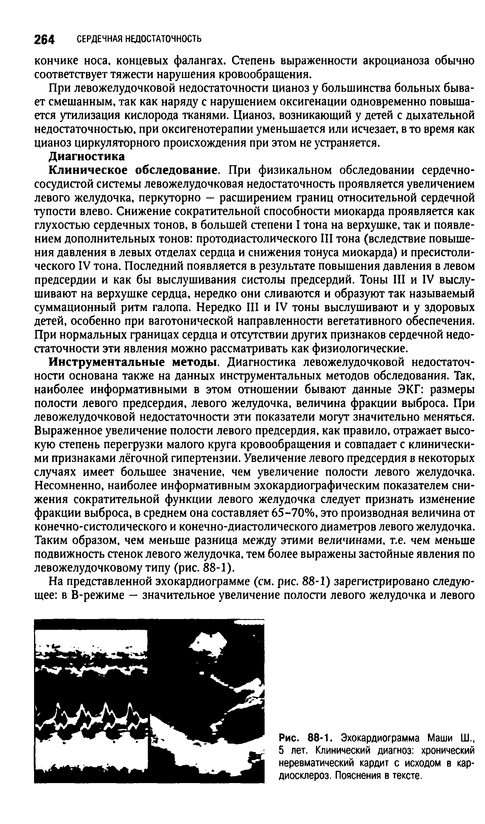 Рис. 88-1. Эхокардиограмма Маши Ш., 5 лет. Клинический диагноз хронический неревматический кардит с исходом в кардиосклероз. Пояснения в тексте.