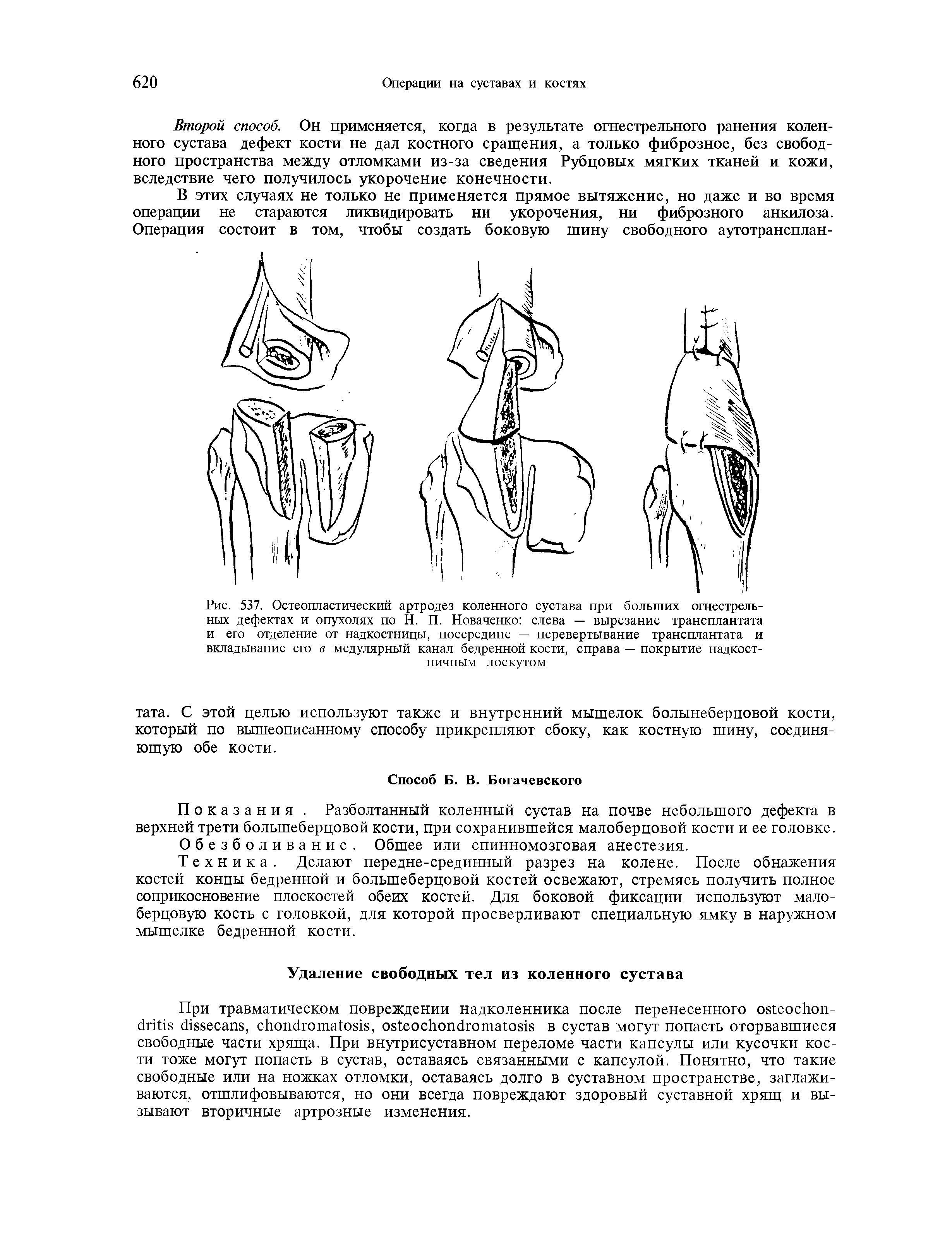 Рис. 537. Остеопластический артродез коленного сустава при больших огнестрельных дефектах и опухолях по Н. П. Новаченко слева — вырезание трансплантата и его отделение от надкостницы, посередине — перевертывание трансплантата и вкладывание его в медулярный канал бедренной кости, справа — покрытие надкостничным лоскутом...