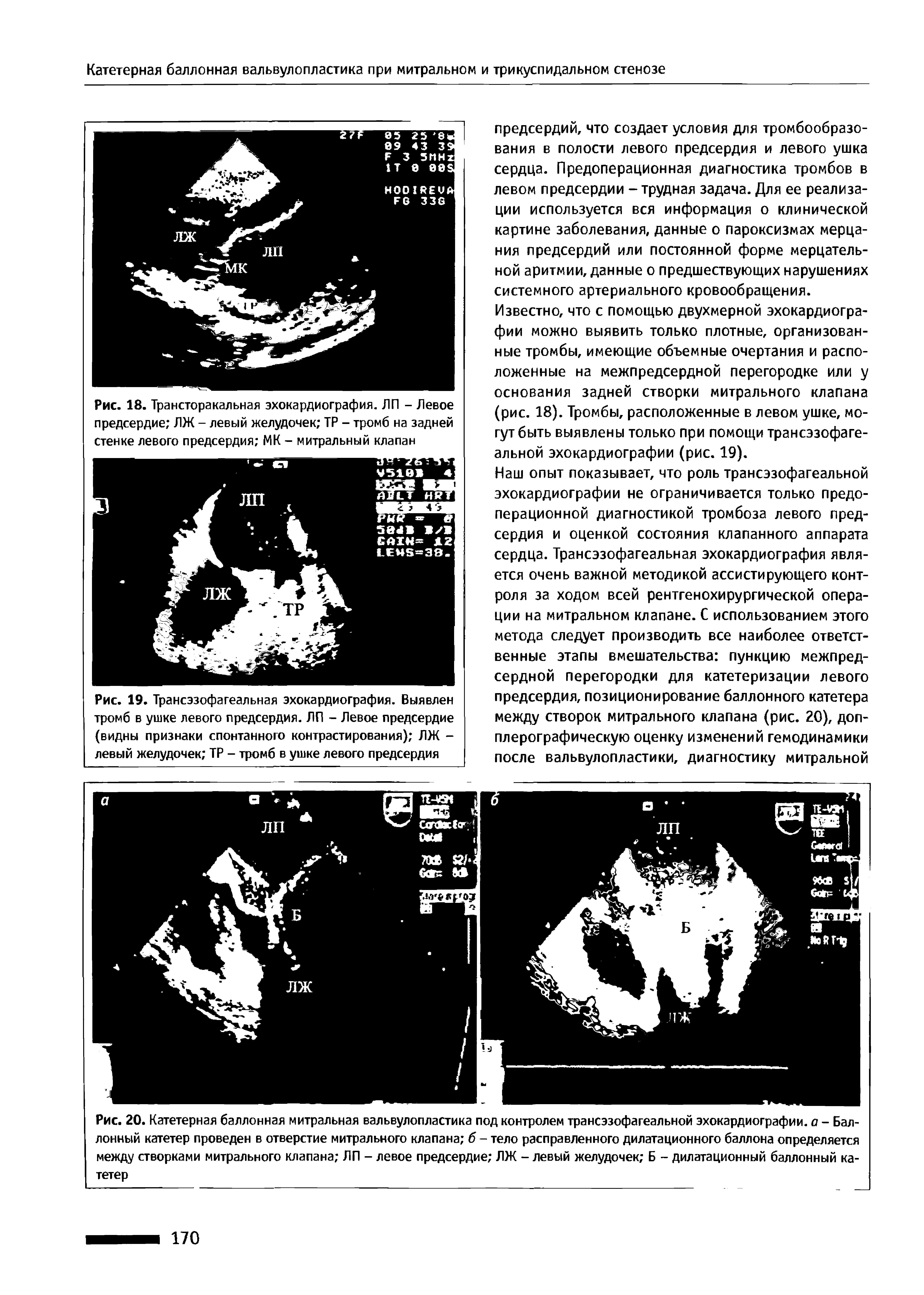 Рис. 19. Трансэзофагеальная эхокардиография. Выявлен тромб в ушке левого предсердия. ЛП - Левое предсердие (видны признаки спонтанного контрастирования) ЛЖ -левый желудочек ТР - тромб в ушке левого предсердия...