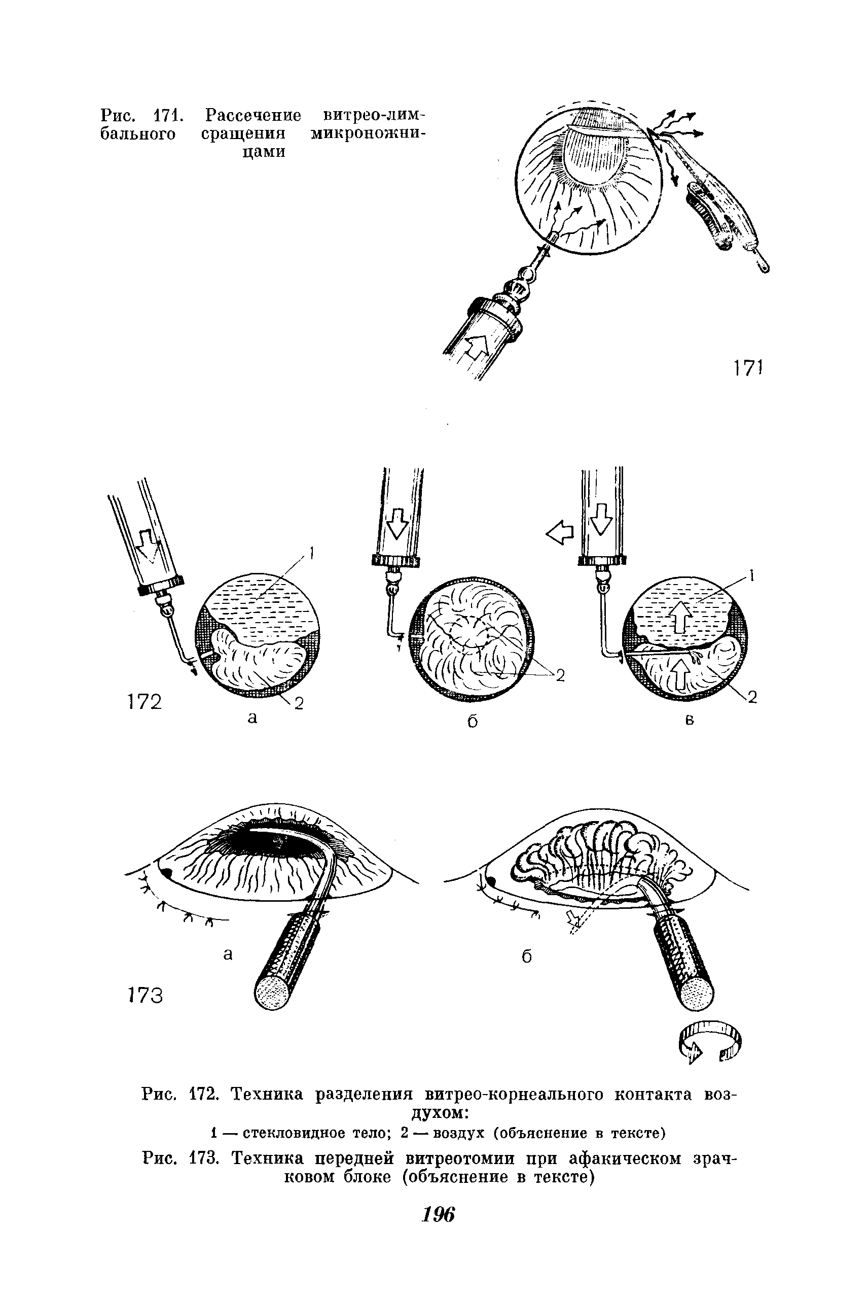 Рис. 173. Техника передней витреотомии при афакическом зрачковом блоке (объяснение в тексте)...