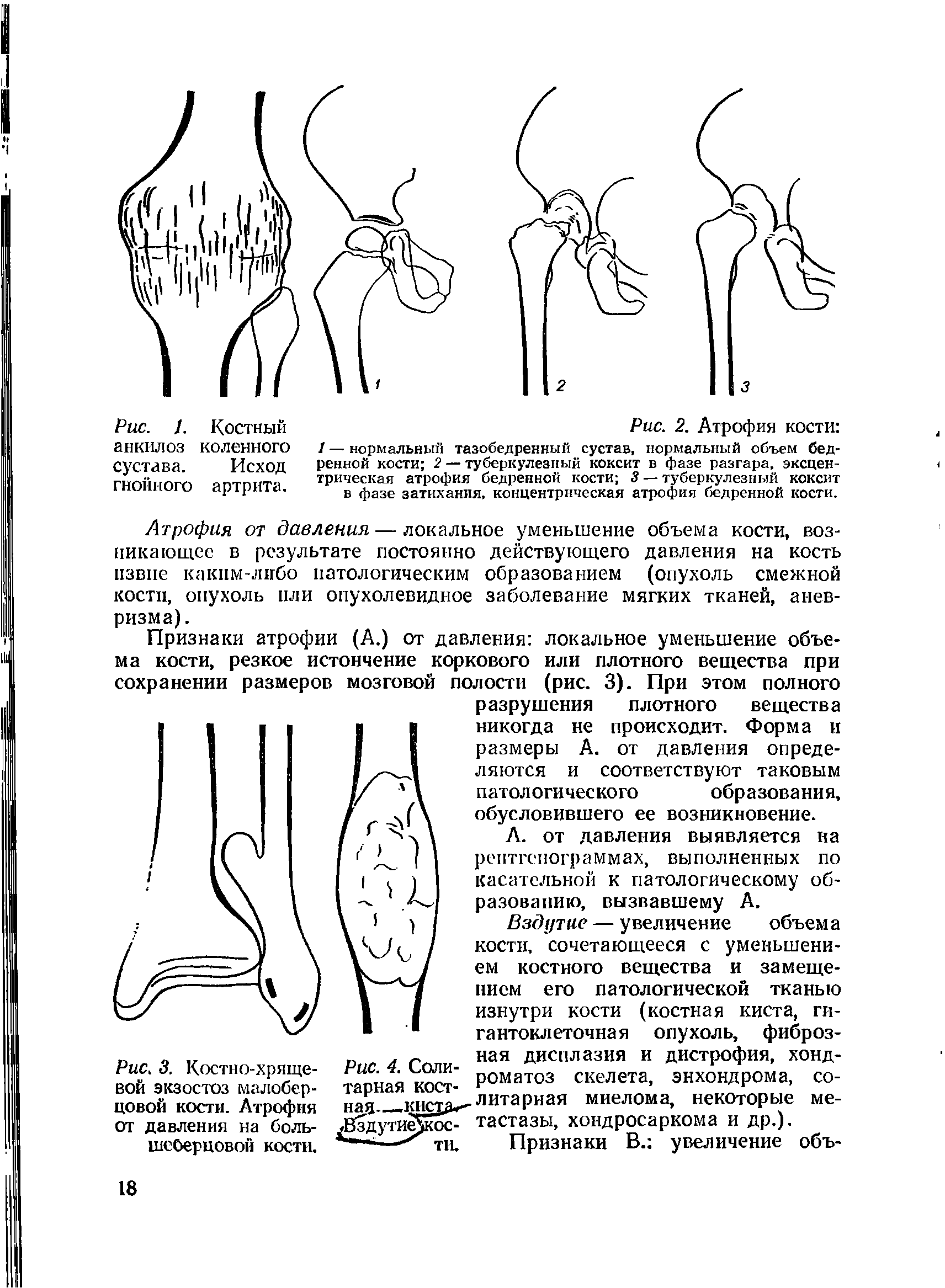 Рис. 3. Костно-хрящевой экзостоз малоберцовой кости. Атрофия от давления на большеберцовой кости.