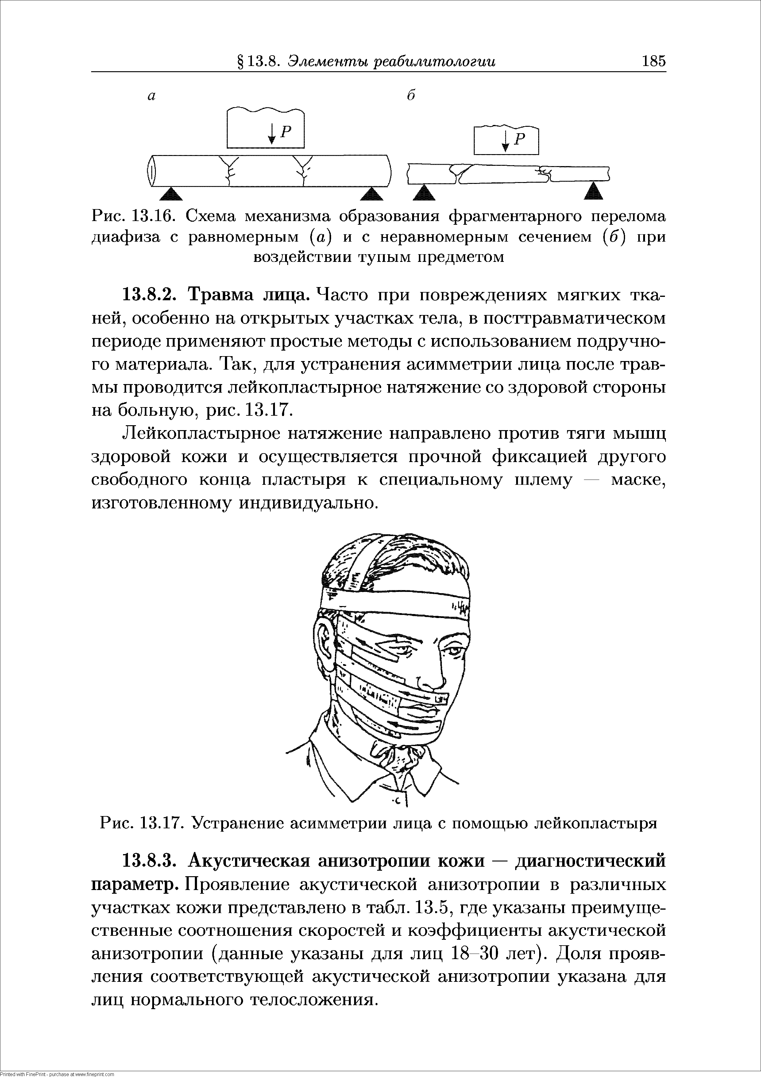 Рис. 13.16. Схема механизма образования фрагментарного перелома диафиза с равномерным (а) и с неравномерным сечением (б) при воздействии тупым предметом...