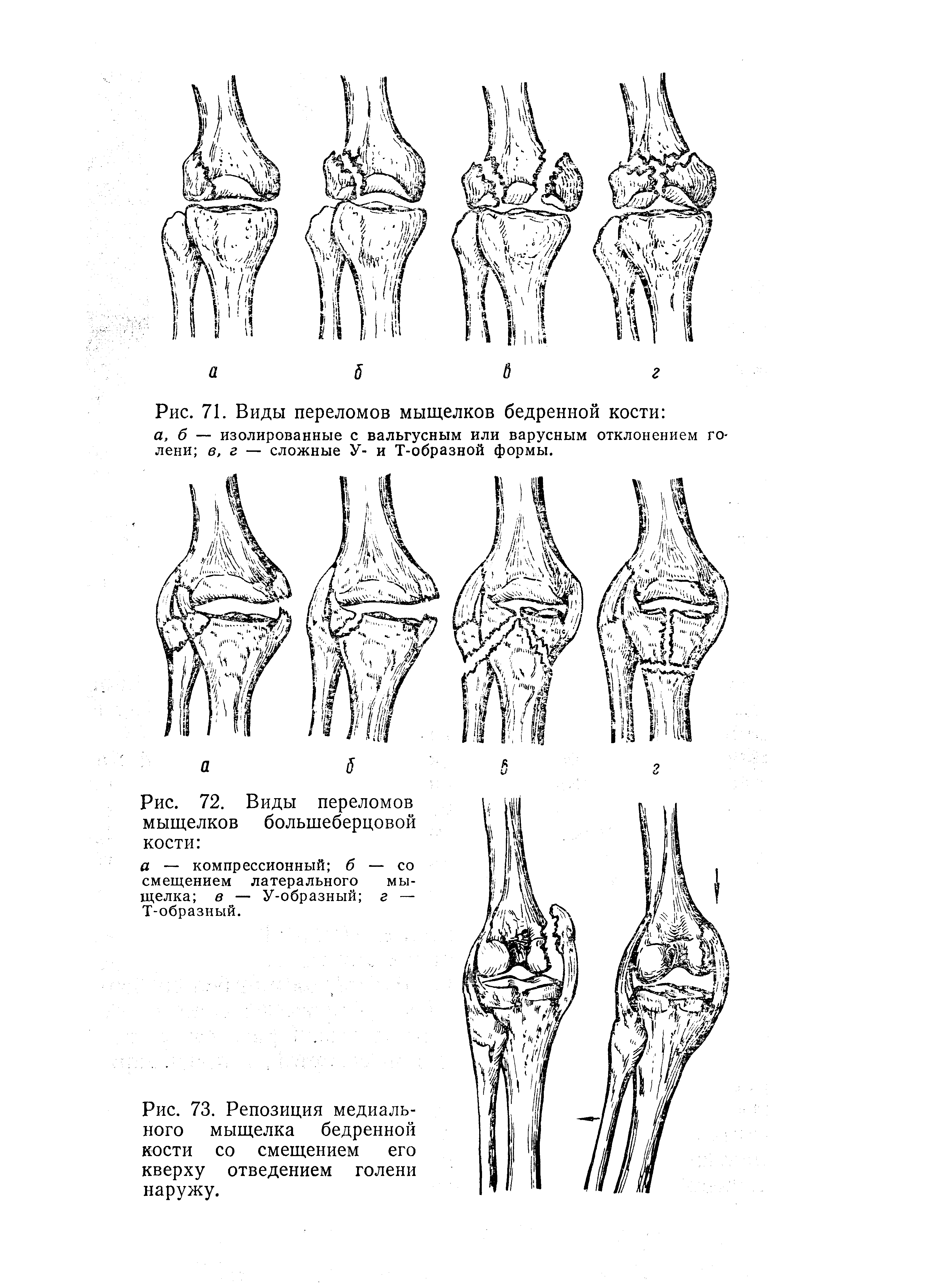 Мыщелки бедренной кости