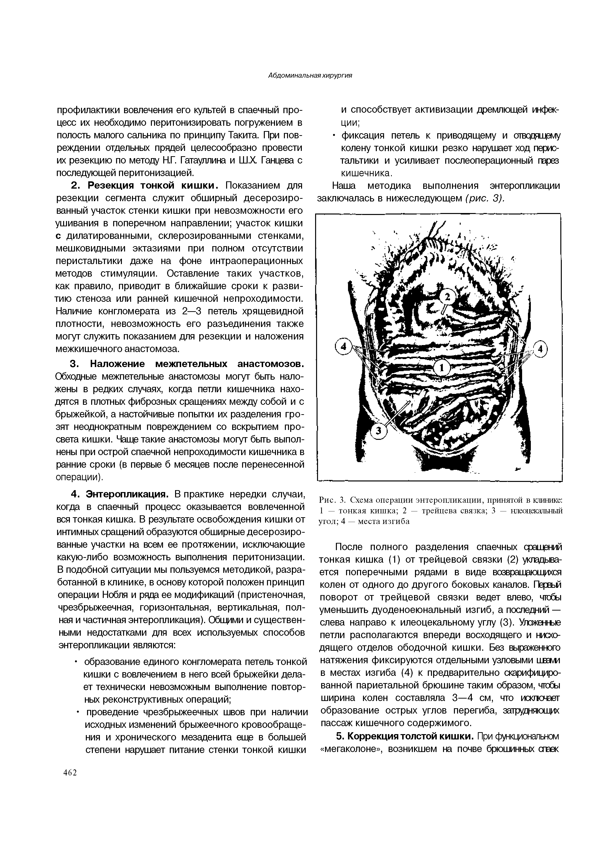 Рис. 3. Схема операции энтеропликации, принятой в клинике 1 — тонкая кишка 2 — трейцева связка 3 — илеоцекальный угол 4 — места изгиба...