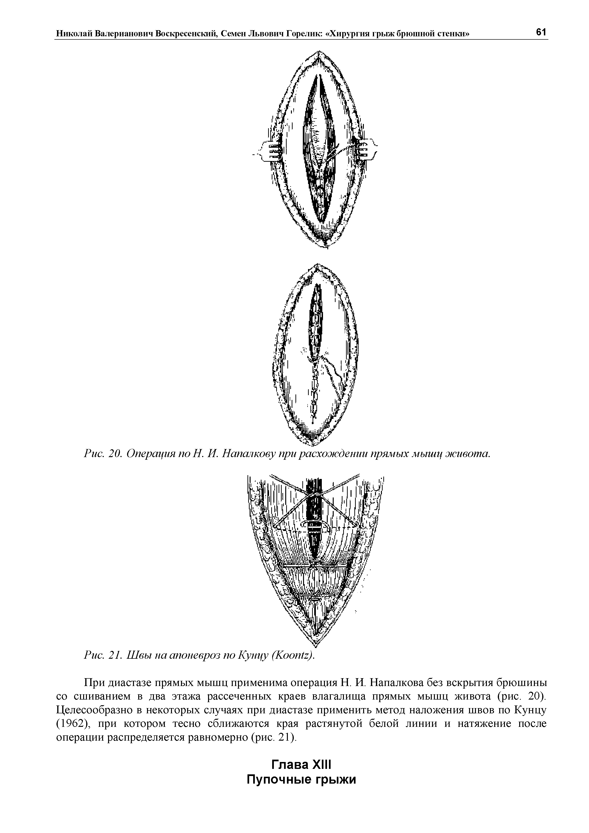 Рис. 20. Операция по Н. И. Напалкову при расхождении прямых мышц живота.