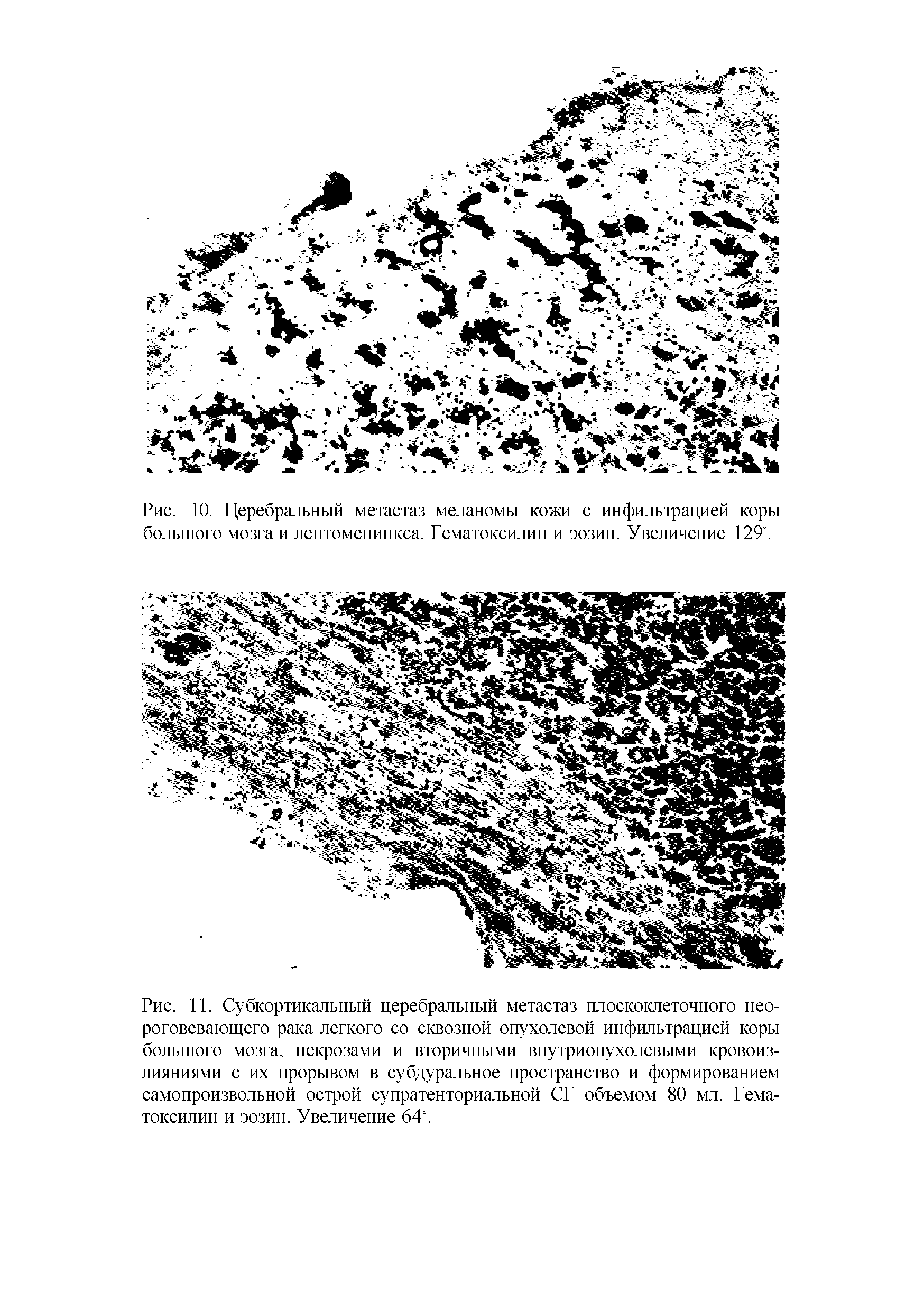 Рис. И. Субкортикальный церебральный метастаз плоскоклеточного нео-роговевающего рака легкого со сквозной опухолевой инфильтрацией коры большого мозга, некрозами и вторичными внутриопухолевыми кровоизлияниями с их прорывом в субдуральное пространство и формированием самопроизвольной острой супратенториальной СГ объемом 80 мл. Гематоксилин и эозин. Увеличение 64х.