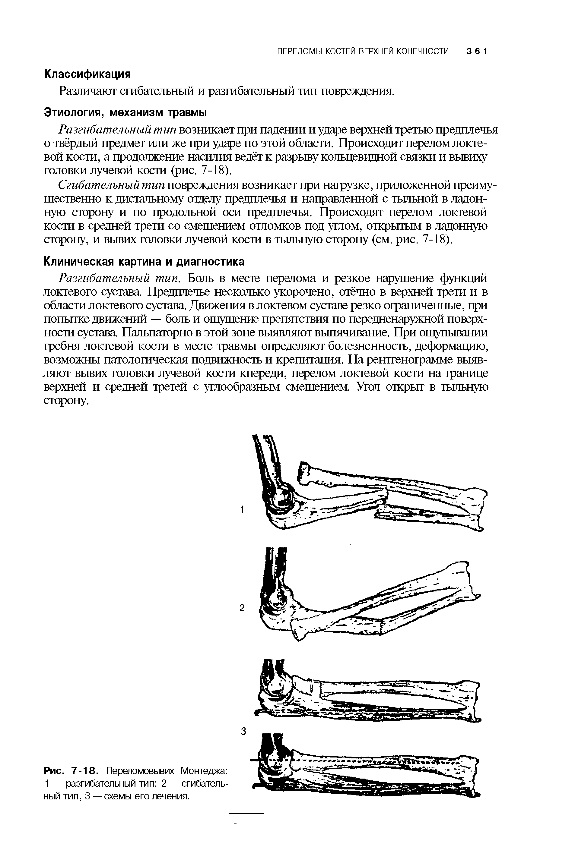 Рис. 7-18. Переломовывих Монтеджа 1 — разгибательный тип 2 — сгибательный тип, 3 — схемы его лечения.