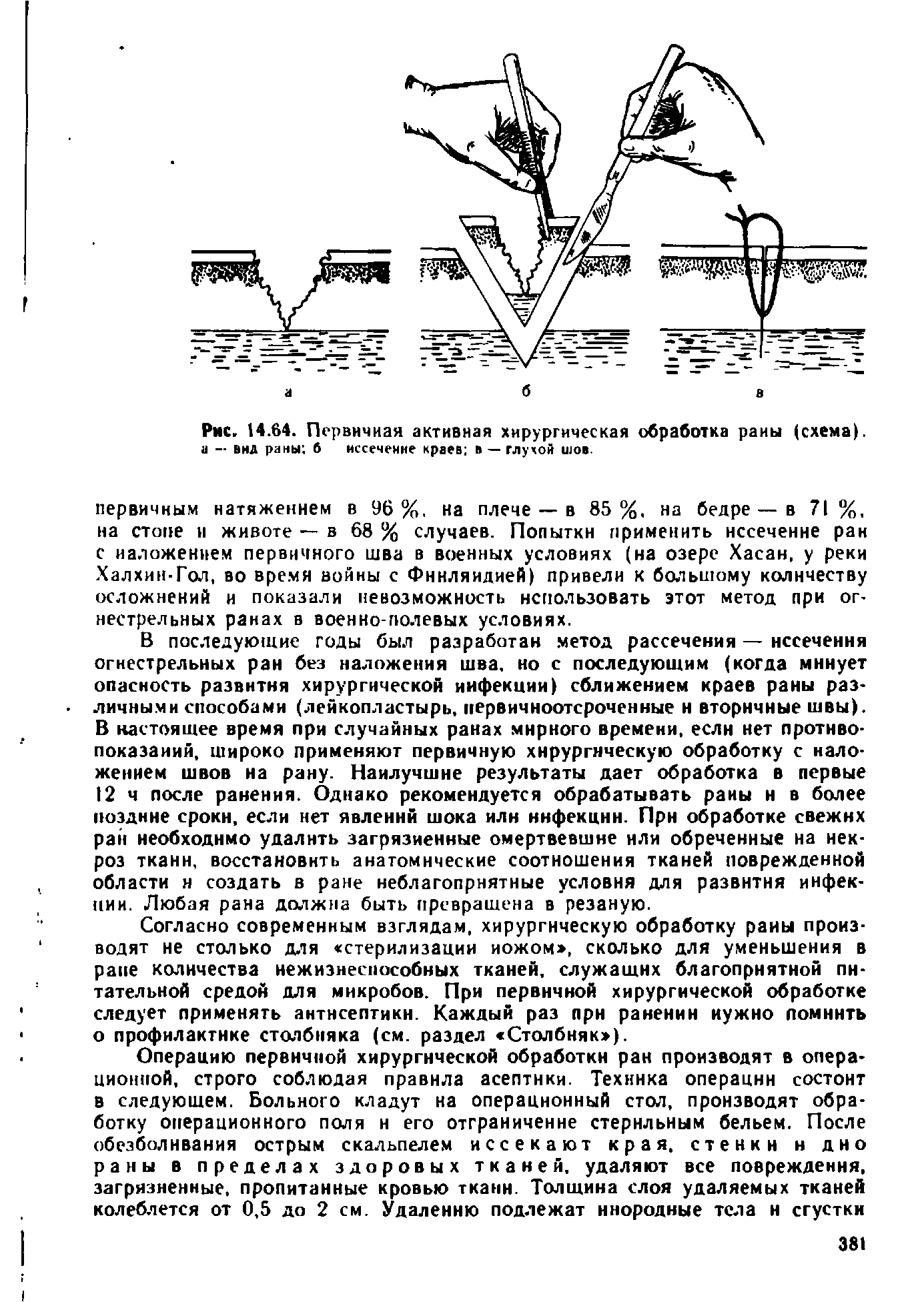 Рис. 14.64. Первичная активная хирургическая обработка раны (схема), и — вид раны б иссечение краев в — глухой шов...