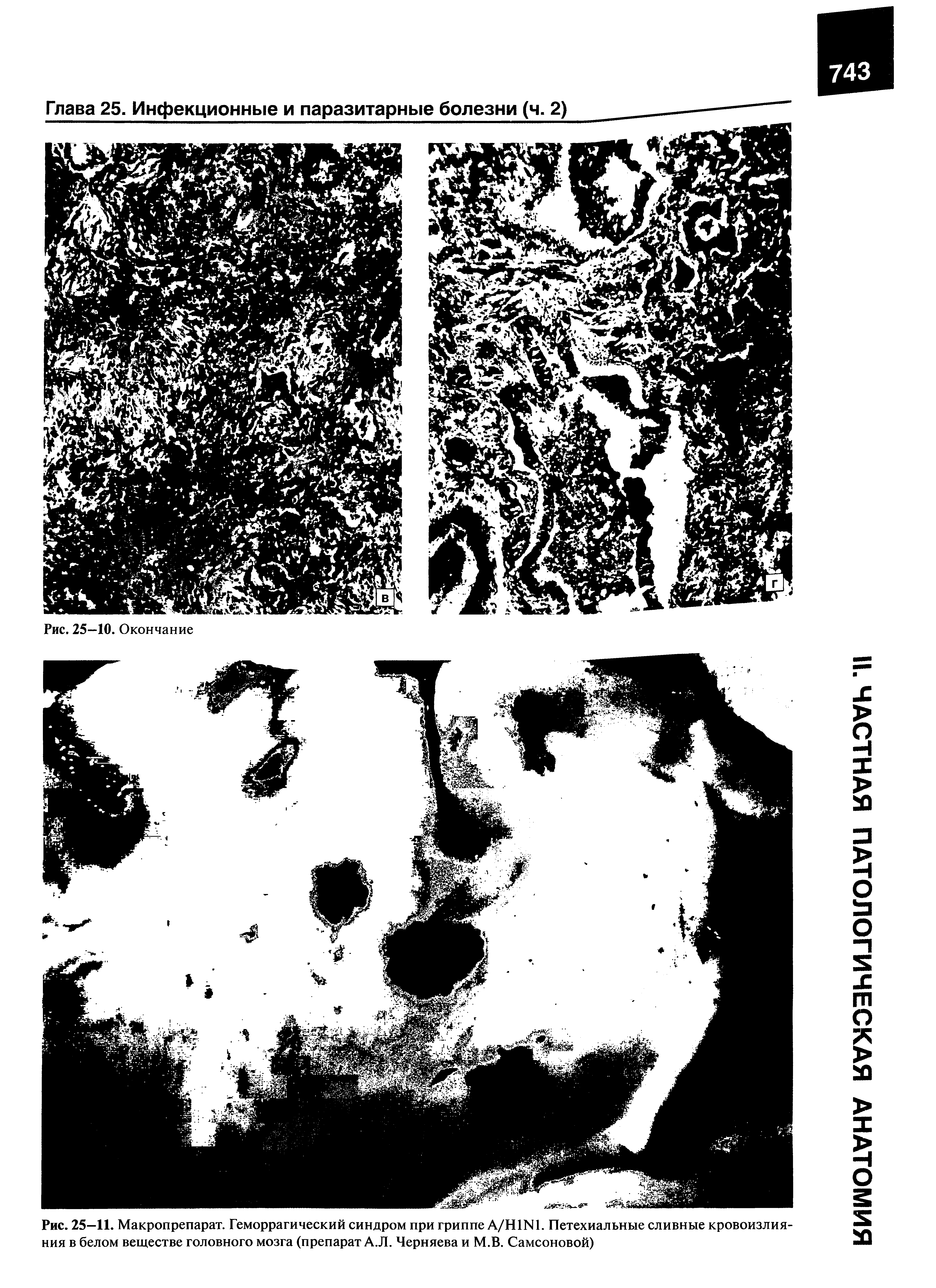 Рис. 25-11. Макропрепарат. Геморрагический синдром при гриппе А/Н1Ы1. Петехиальные сливные кровоизлияния в белом веществе головного мозга (препарат А.Л. Черняева и М.В. Самсоновой)...