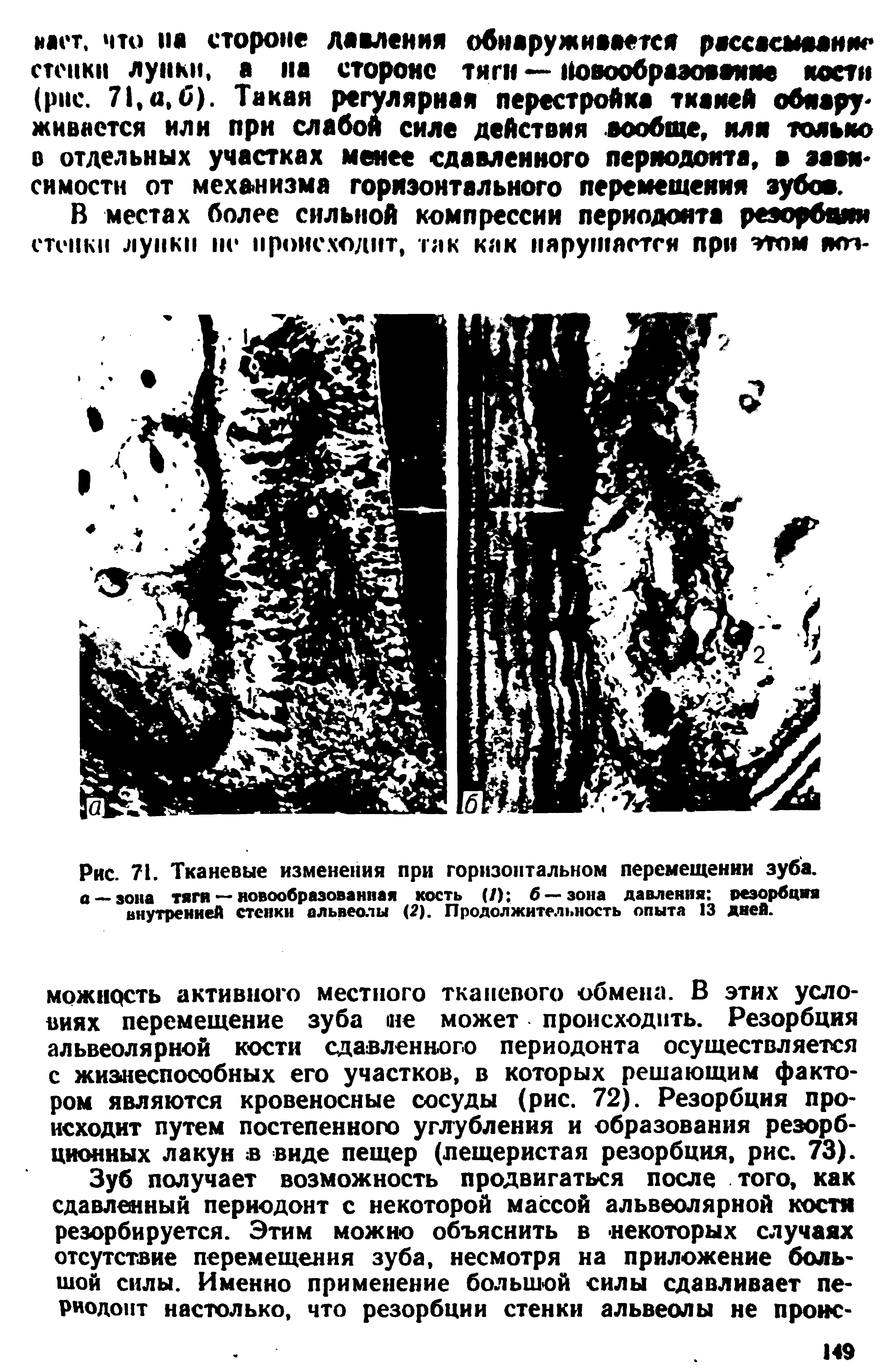 Рис. 71. Тканевые изменения при горизонтальном перемещении зуба, а — зона тяги — новообразованная кость (/) б —зона давления резорбция внутренней стенки альвеолы (2). Продолжительность опыта 13 дней.