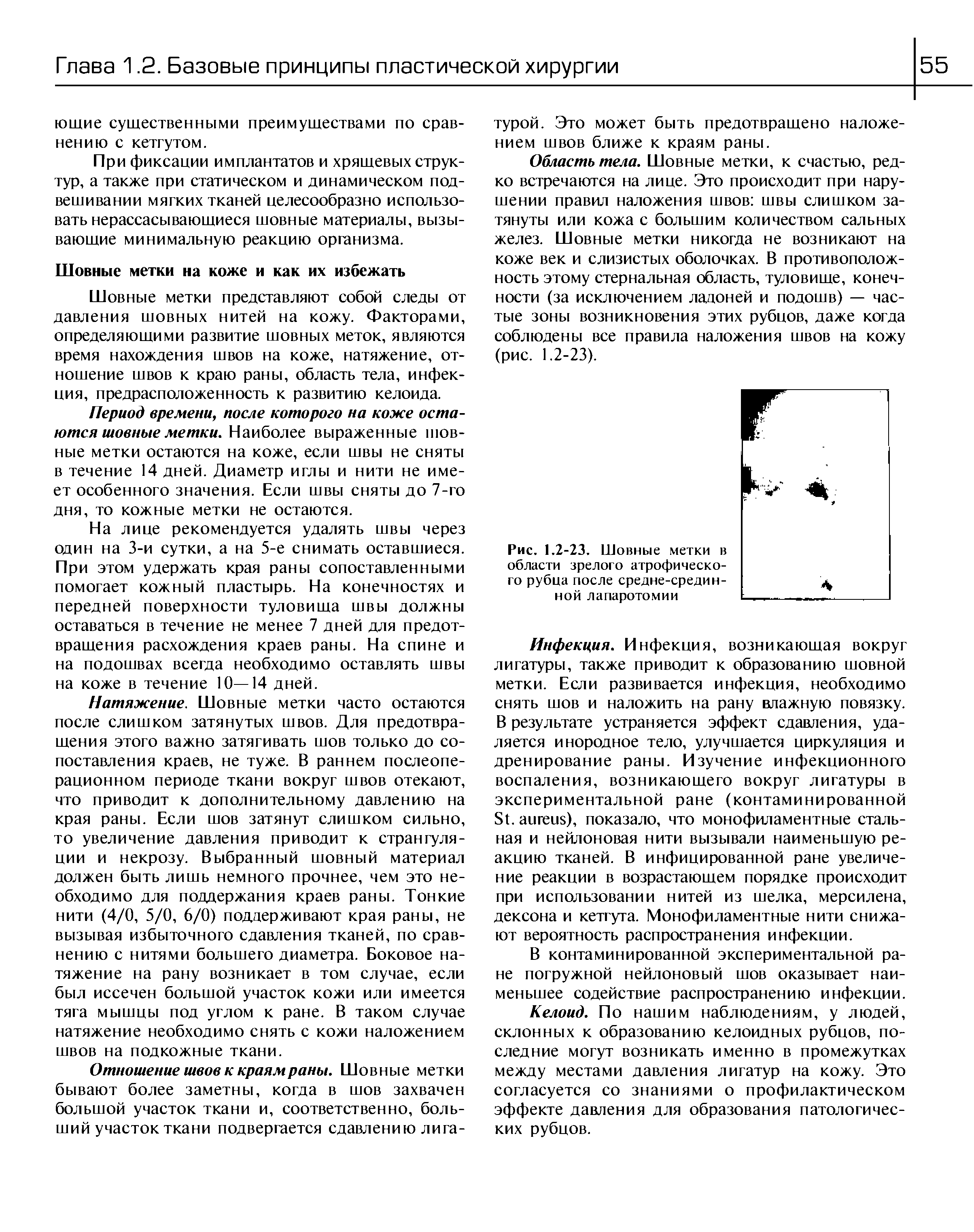 Рис. 1.2-23. Шовные метки в области зрелого атрофического рубца после средне-срединной лапаротомии...