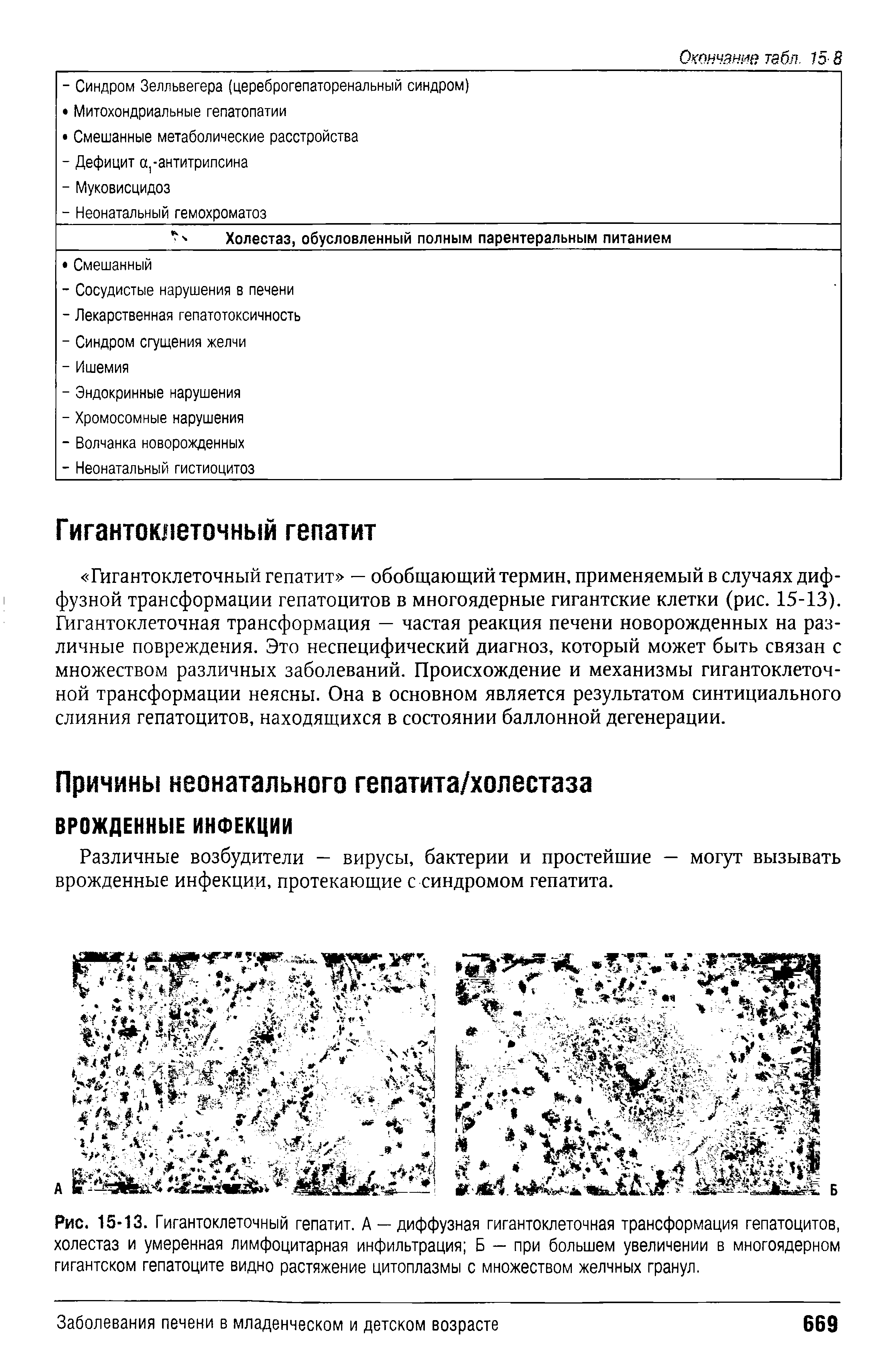 Рис. 15-13. Гигантоклеточный гепатит. А —диффузная гигантоклеточная трансформация гепатоцитов, холестаз и умеренная лимфоцитарная инфильтрация Б — при большем увеличении в многоядерном гигантском гепатоците видно растяжение цитоплазмы с множеством желчных гранул.