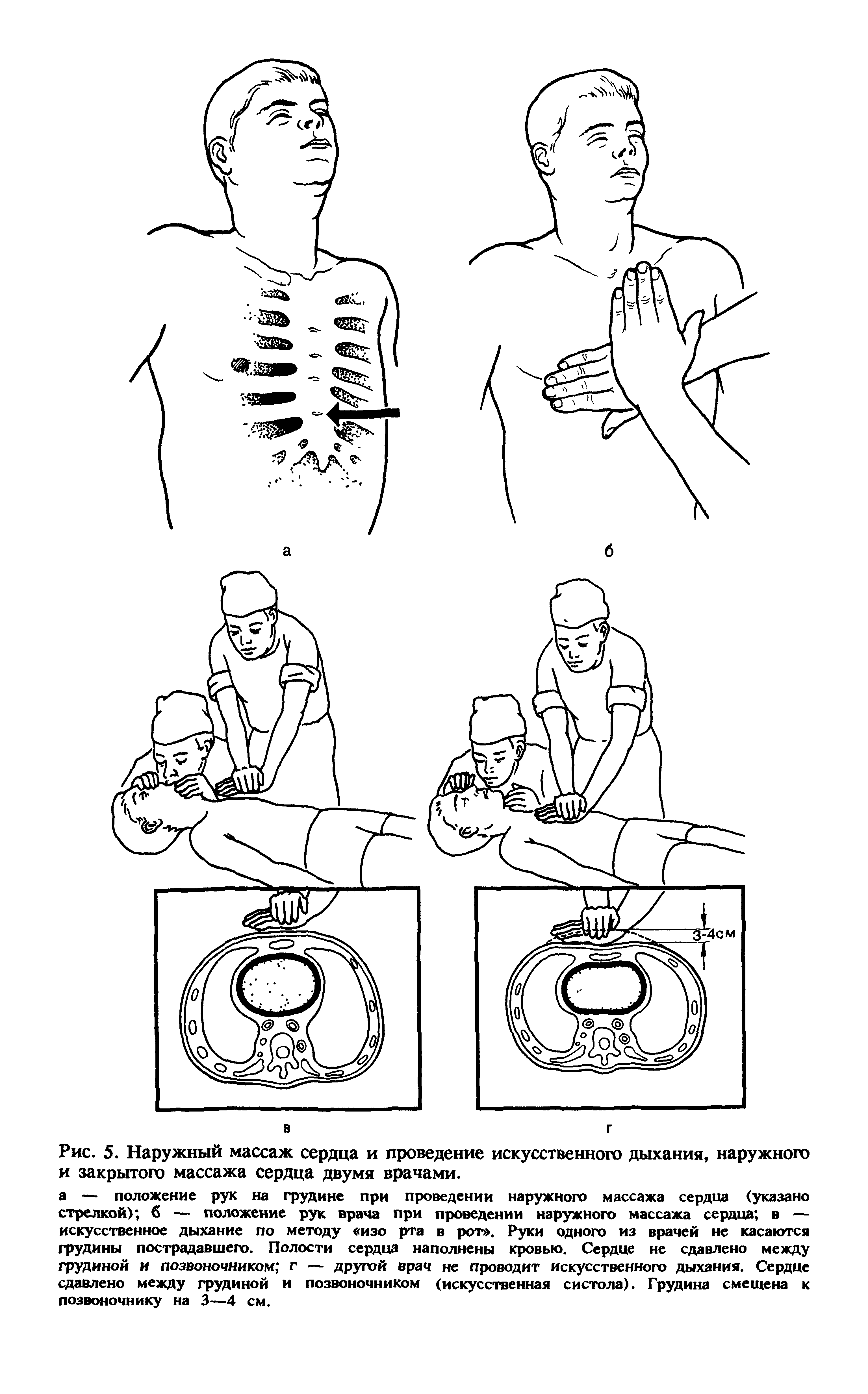 Рис. 5. Наружный массаж сердца и проведение искусственного дыхания, наружного и закрытого массажа сердца двумя врачами.