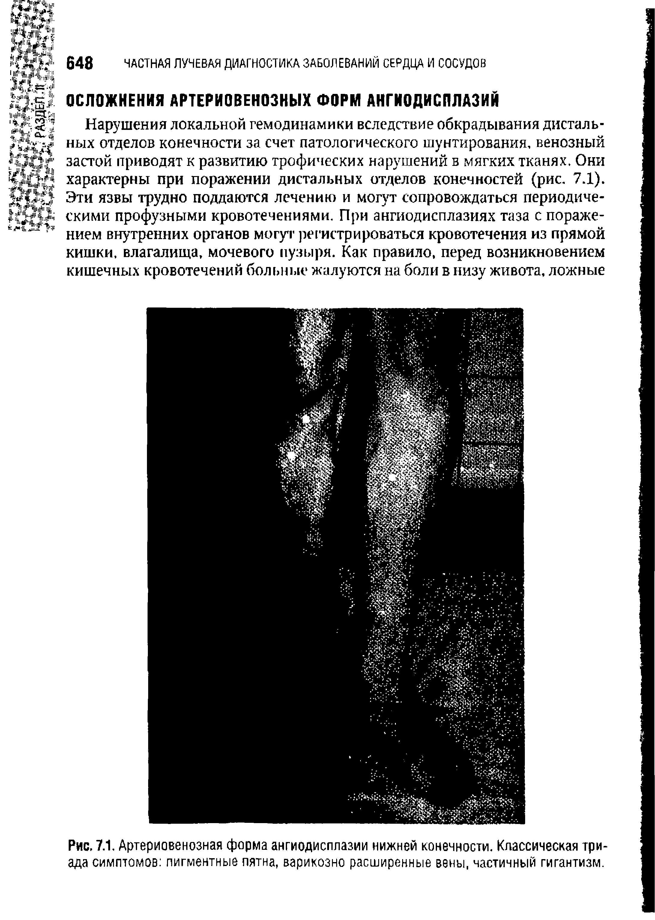 Рис. 7.1. Артериовенозная форма ангиодисплазии нижней конечности. Классическая триада симптомов пигментные пятна, варикозно расширенные вены, частичный гигантизм.