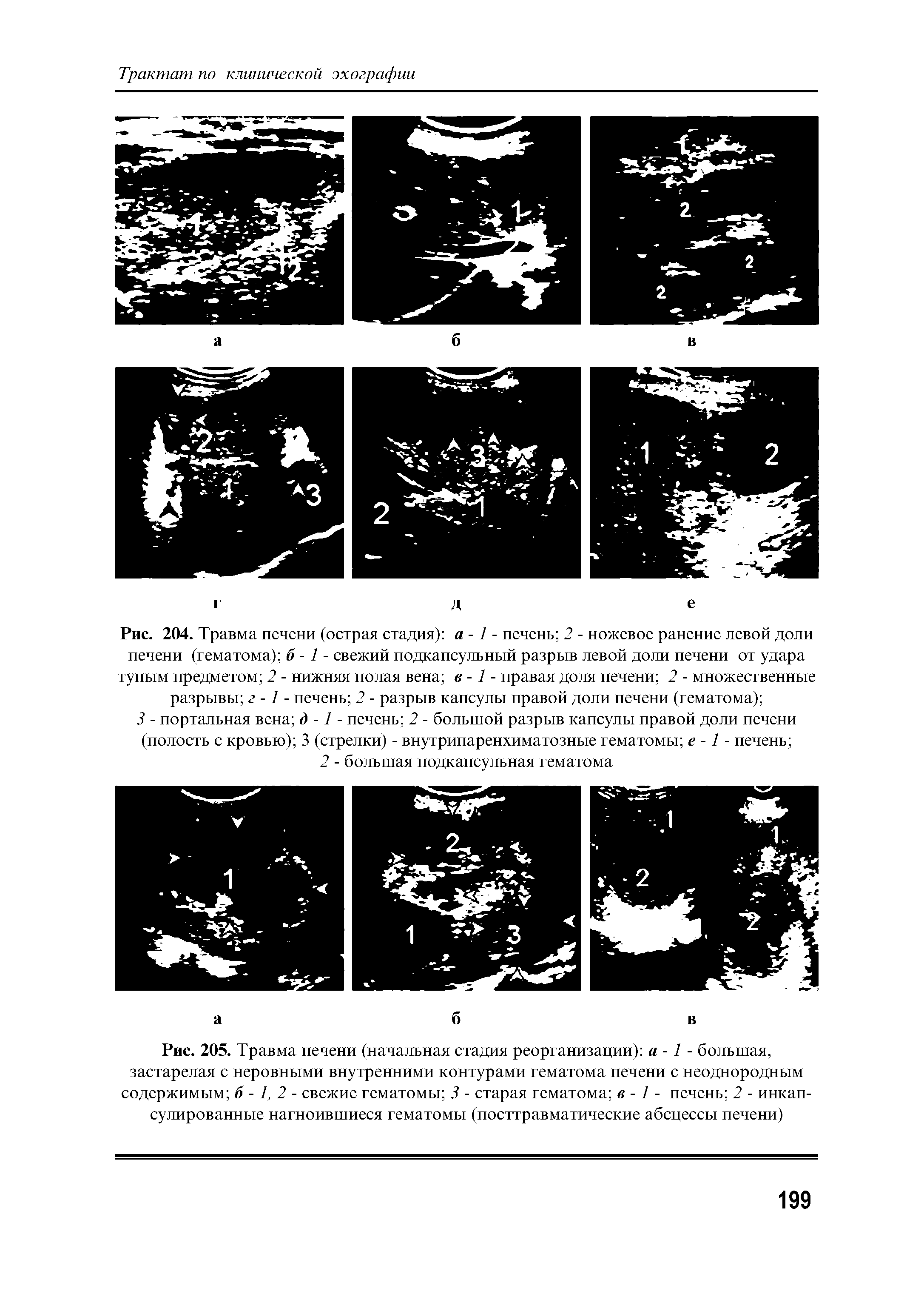 Рис. 205. Травма печени (начальная стадия реорганизации) а -1 - большая, застарелая с неровными внутренними контурами гематома печени с неоднородным содержимым 6-1,2- свежие гематомы 3 - старая гематома в -1 - печень 2 - инкапсулированные нагноившиеся гематомы (посттравматические абсцессы печени)...