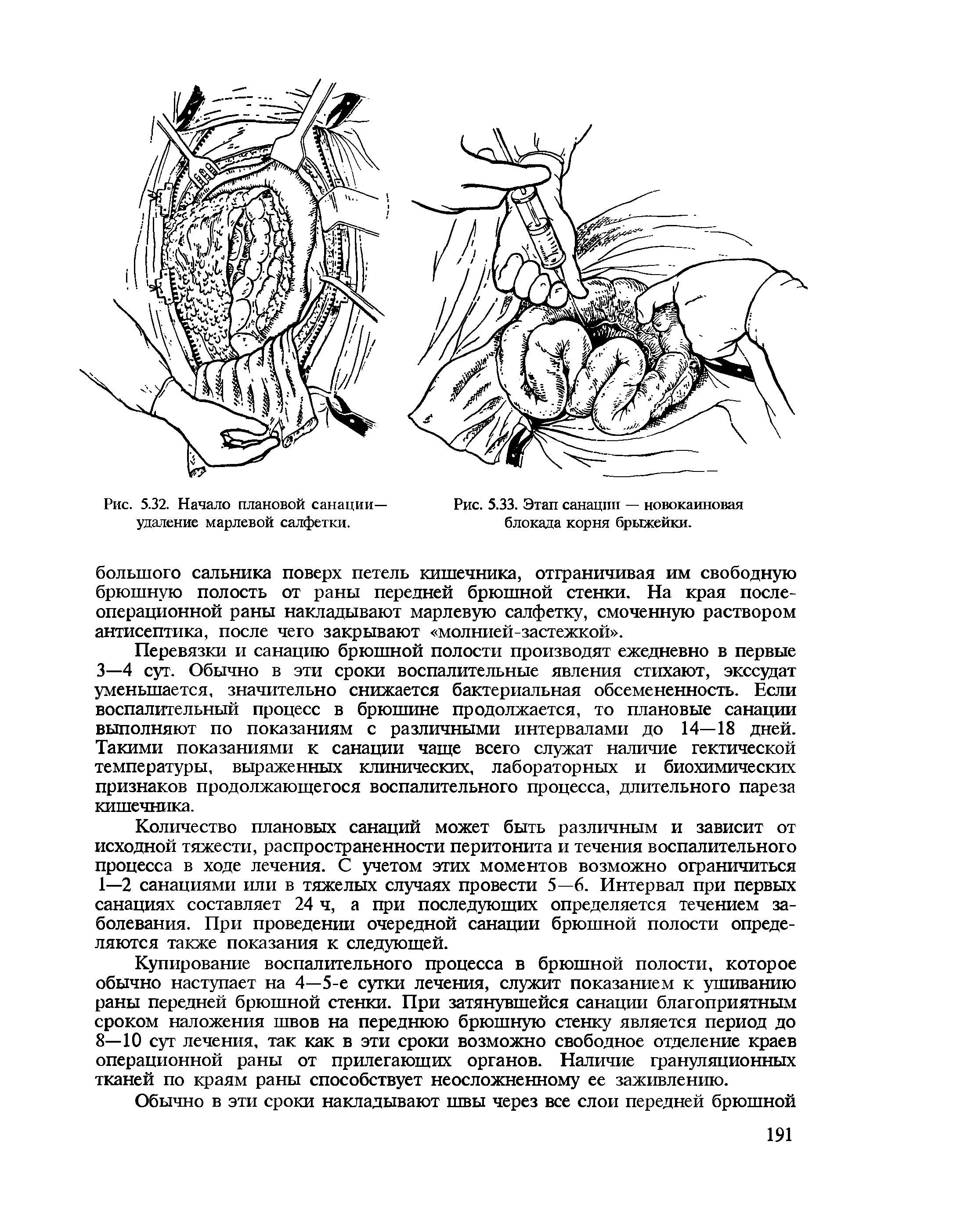 Рис. 5.33. Этап санации — новокаиновая блокада корня брыжейки.