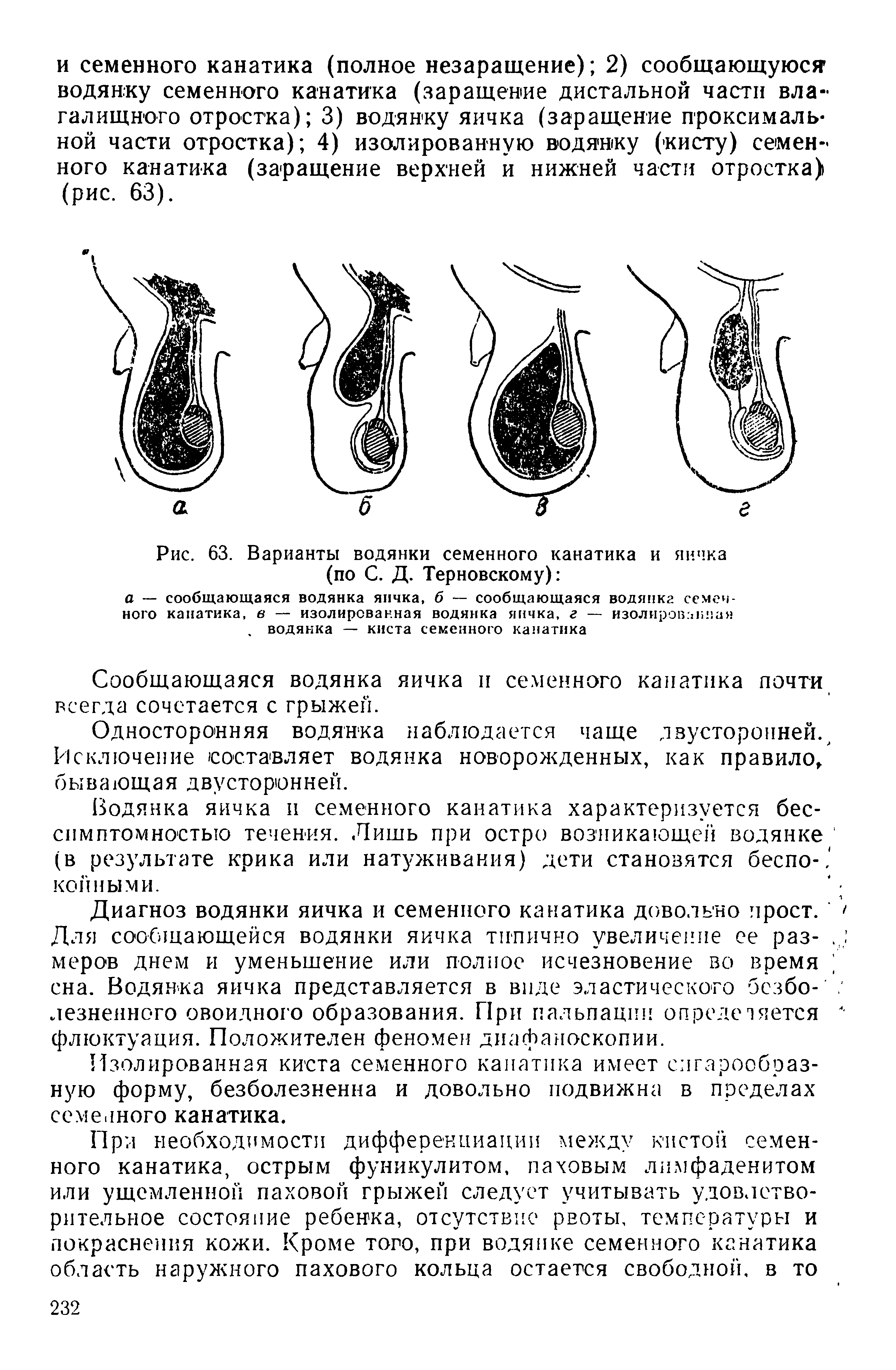 Рис. 63. Варианты водянки семенного канатика и яичка (по С. Д. Терновскому) ...