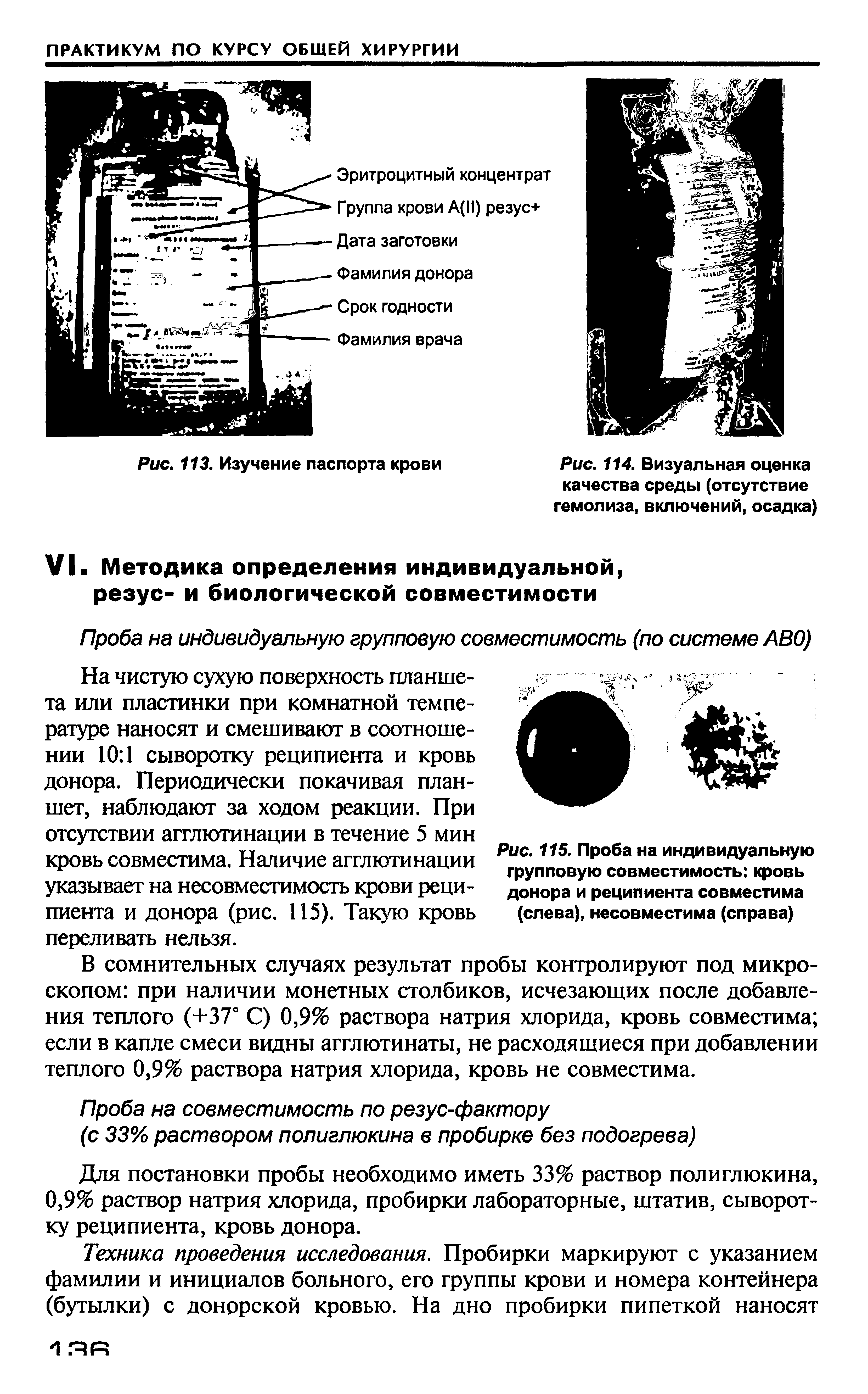 Рис. 115. Проба на индивидуальную групповую совместимость кровь донора и реципиента совместима (слева), несовместима (справа)...