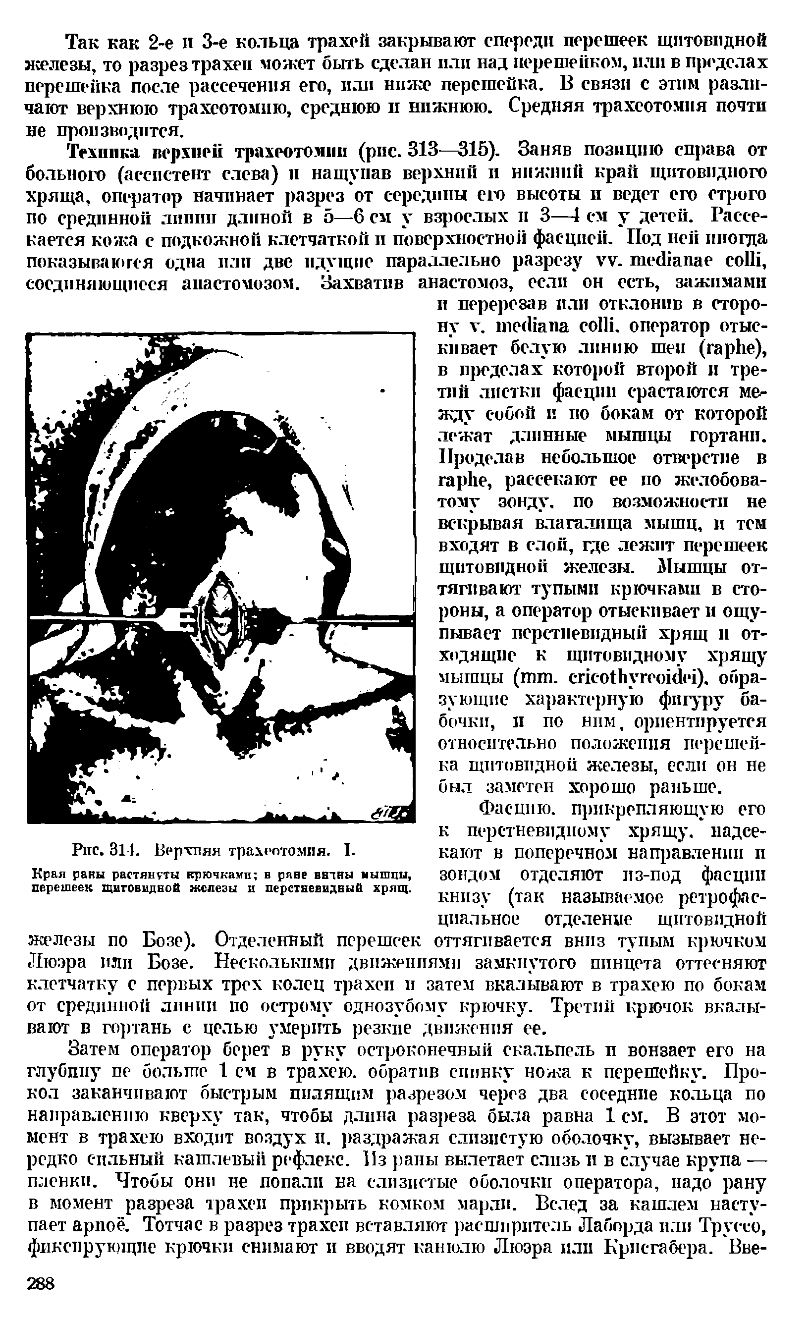 Рис. 314. Верхняя трахеотомия. I. Края раны растянуты крючками в рлне ввлны мышцы, перешеек щитовидной железы и перстневидный хрящ.