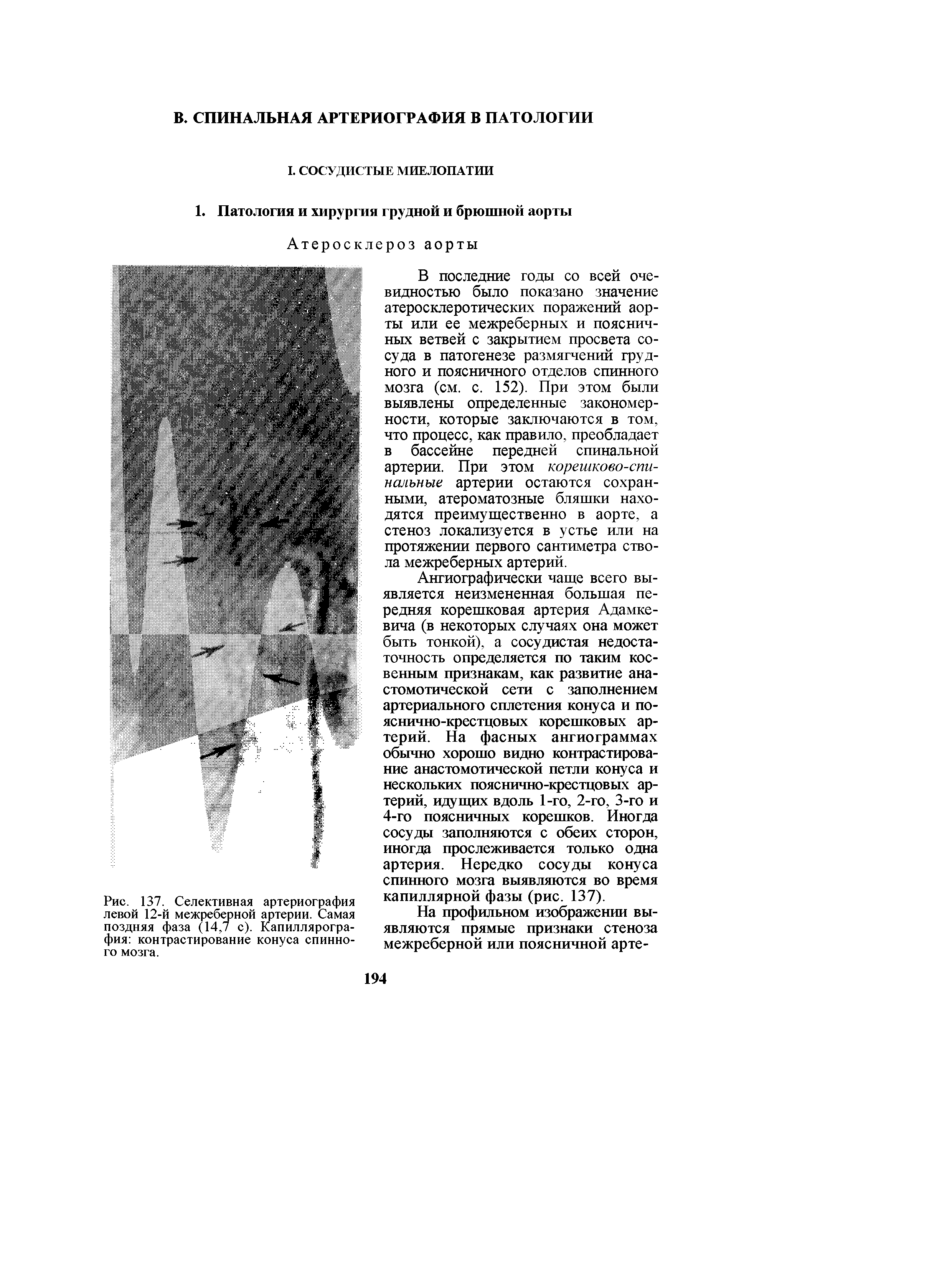 Рис. 137. Селективная артериография левой 12-й межреберной артерии. Самая поздняя фаза (14,7 с). Капиллярография контрастирование конуса спинного мозга.