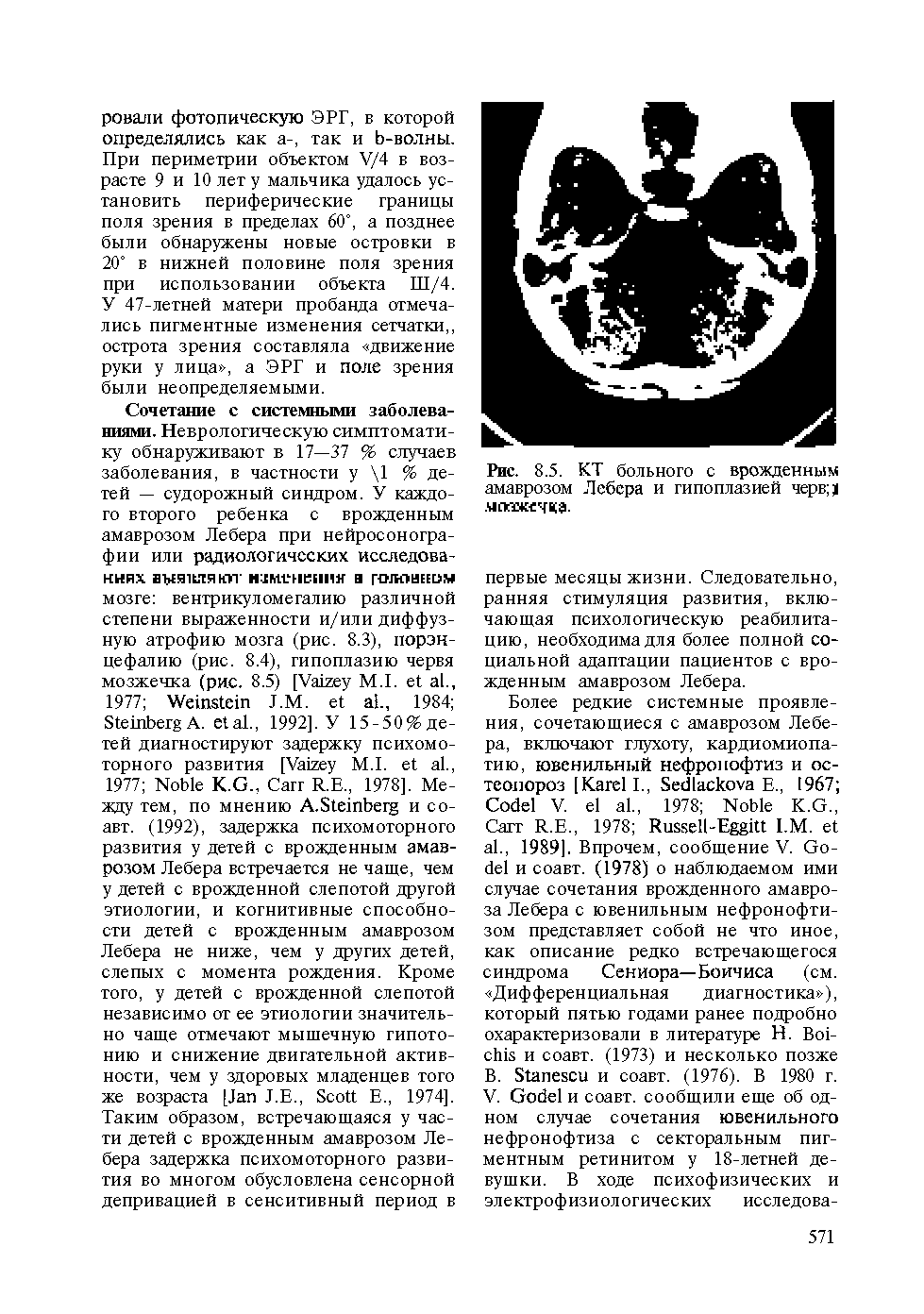 Рис. 8.5. КТ больного с врожденным амаврозом Лебера и гипоплазией черв . чегакечка.