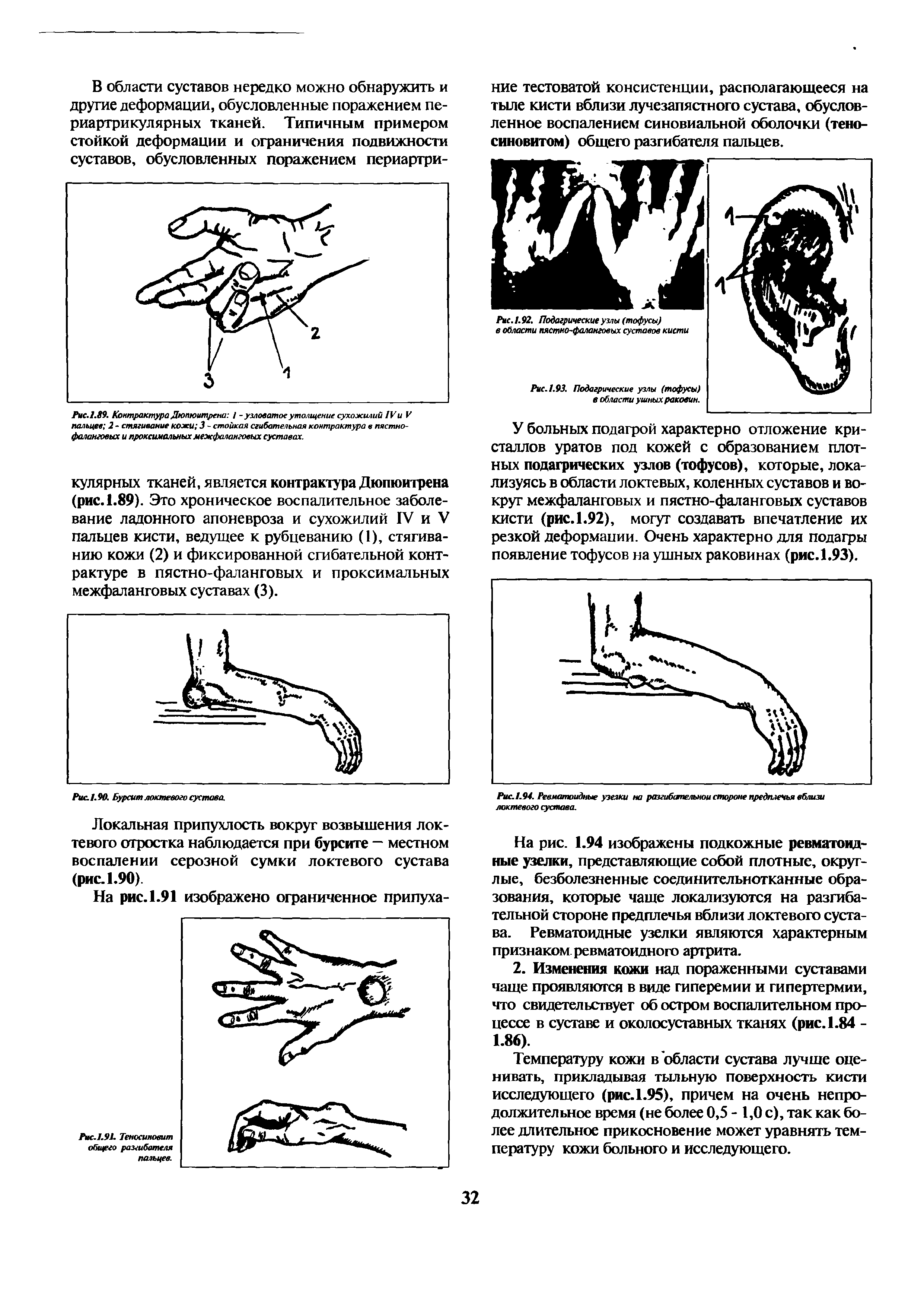 Рис. 1.92. Подагрические узлы (тофусы) в области пястно-фаланговых суставов кисти...