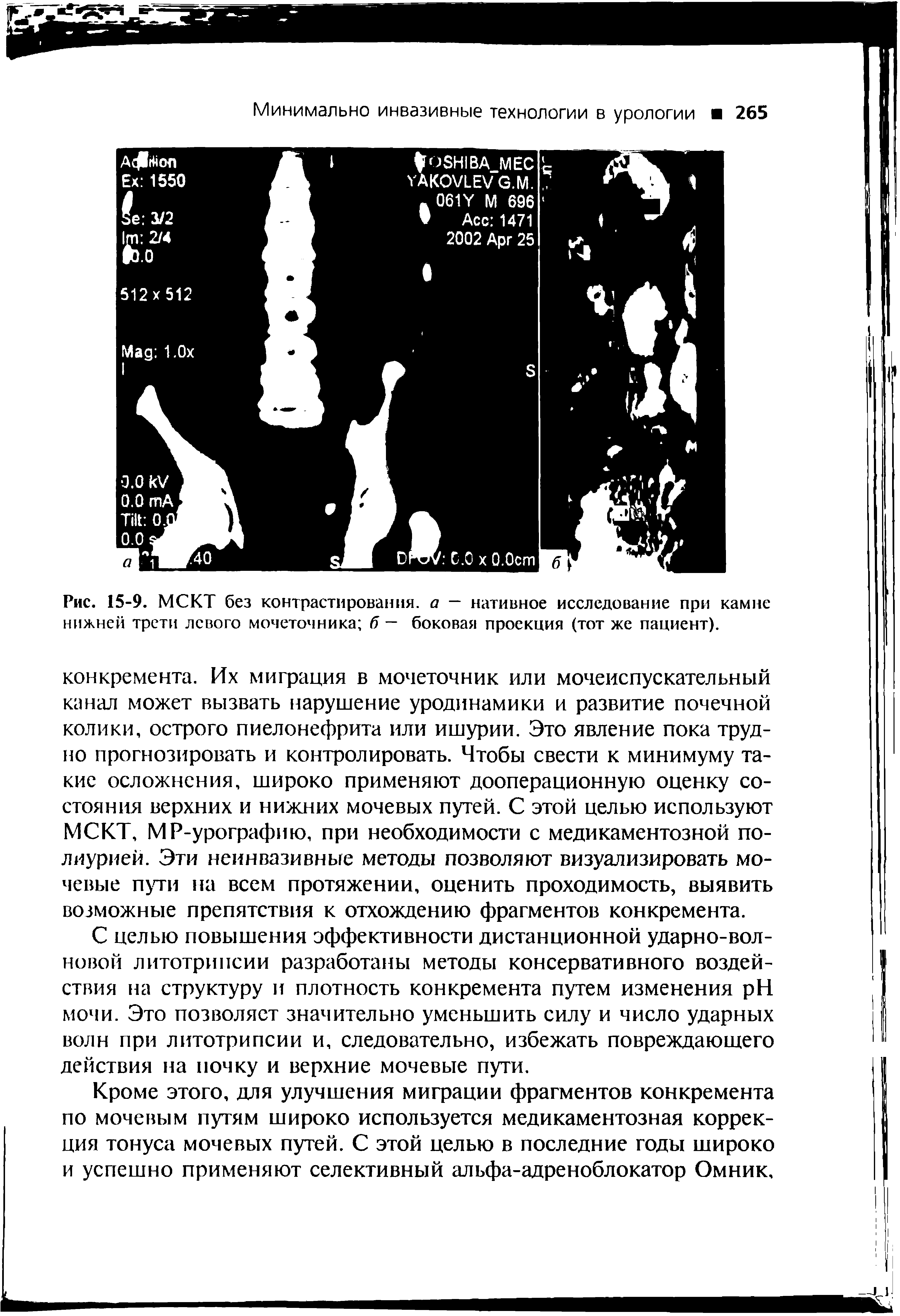 Рис. 15-9. МСКТ без контрастирования, а — нативное исследование при камне нижней трети левого мочеточника б — боковая проекция (тот же пациент).